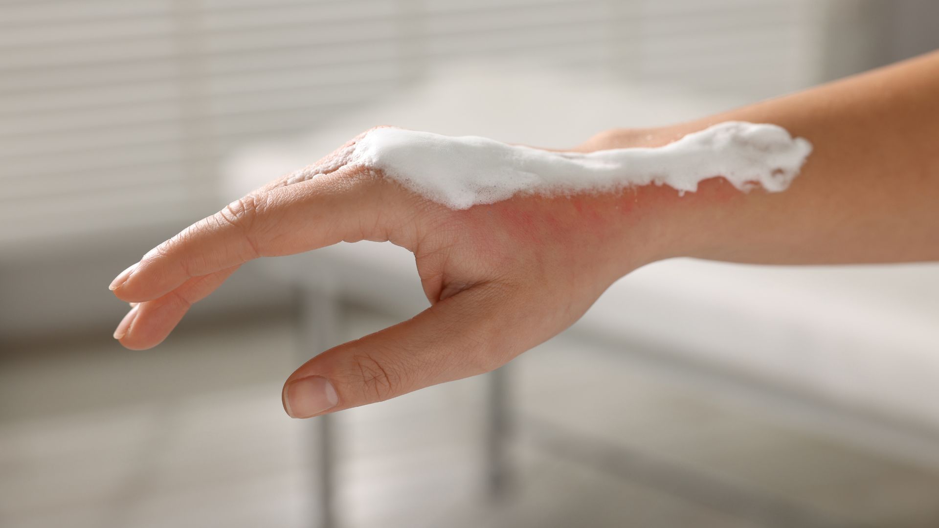 Tuyệt đối không được sử dụng kem đánh răng bôi lên vết bỏng