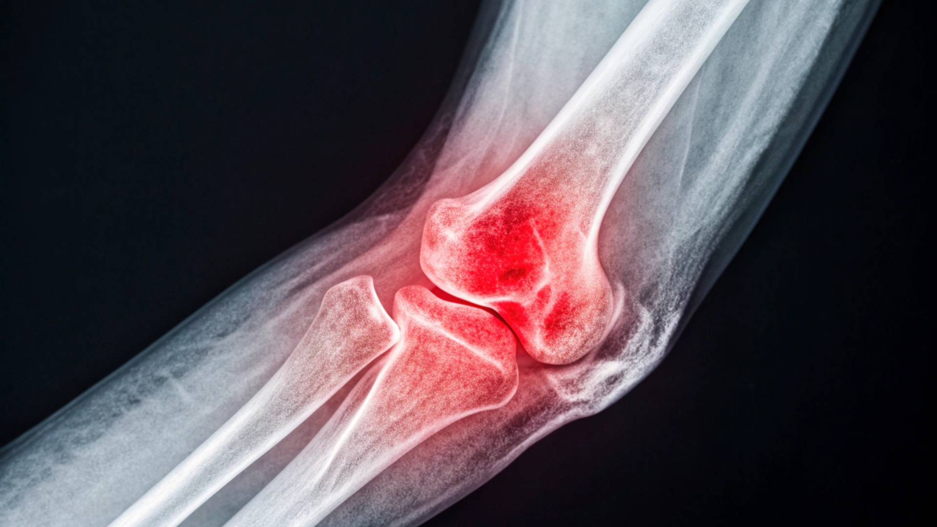 Bong gân ở khuỷu tay thường gây đau và khó cử động tại khớp