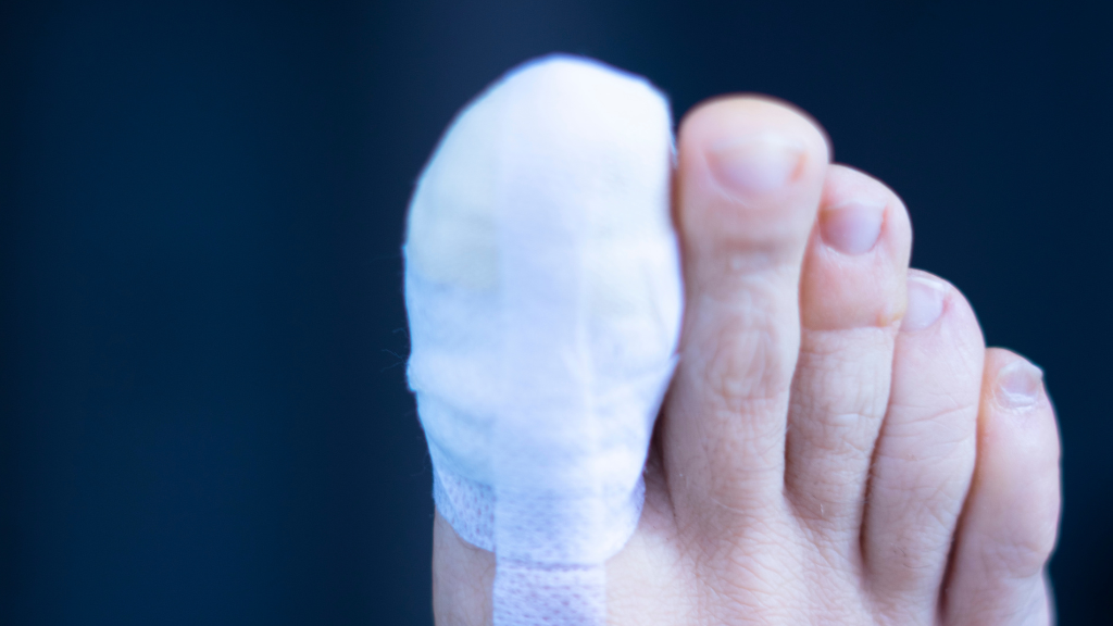 Bong gân ngón chân cái là gì?