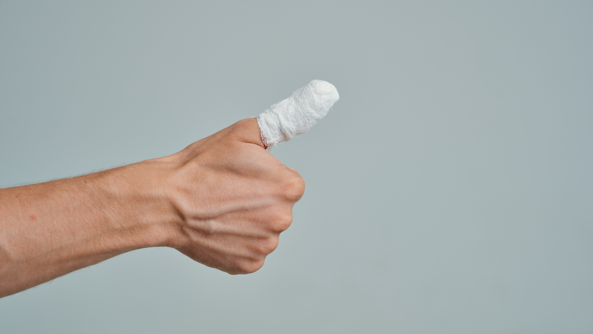 Bong gân ngón tay cái cần được xử trí đúng ngay từ đầu để tránh biến chứng lâu dài