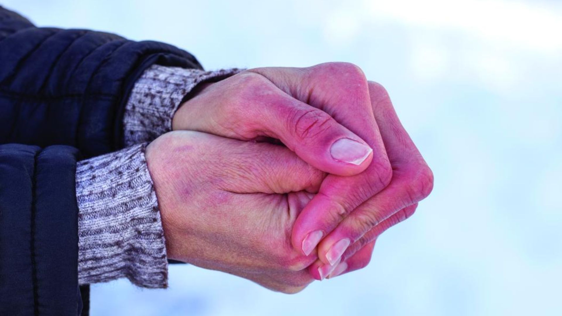 Da đổi màu là triệu chứng thường gặp của bỏng lạnh