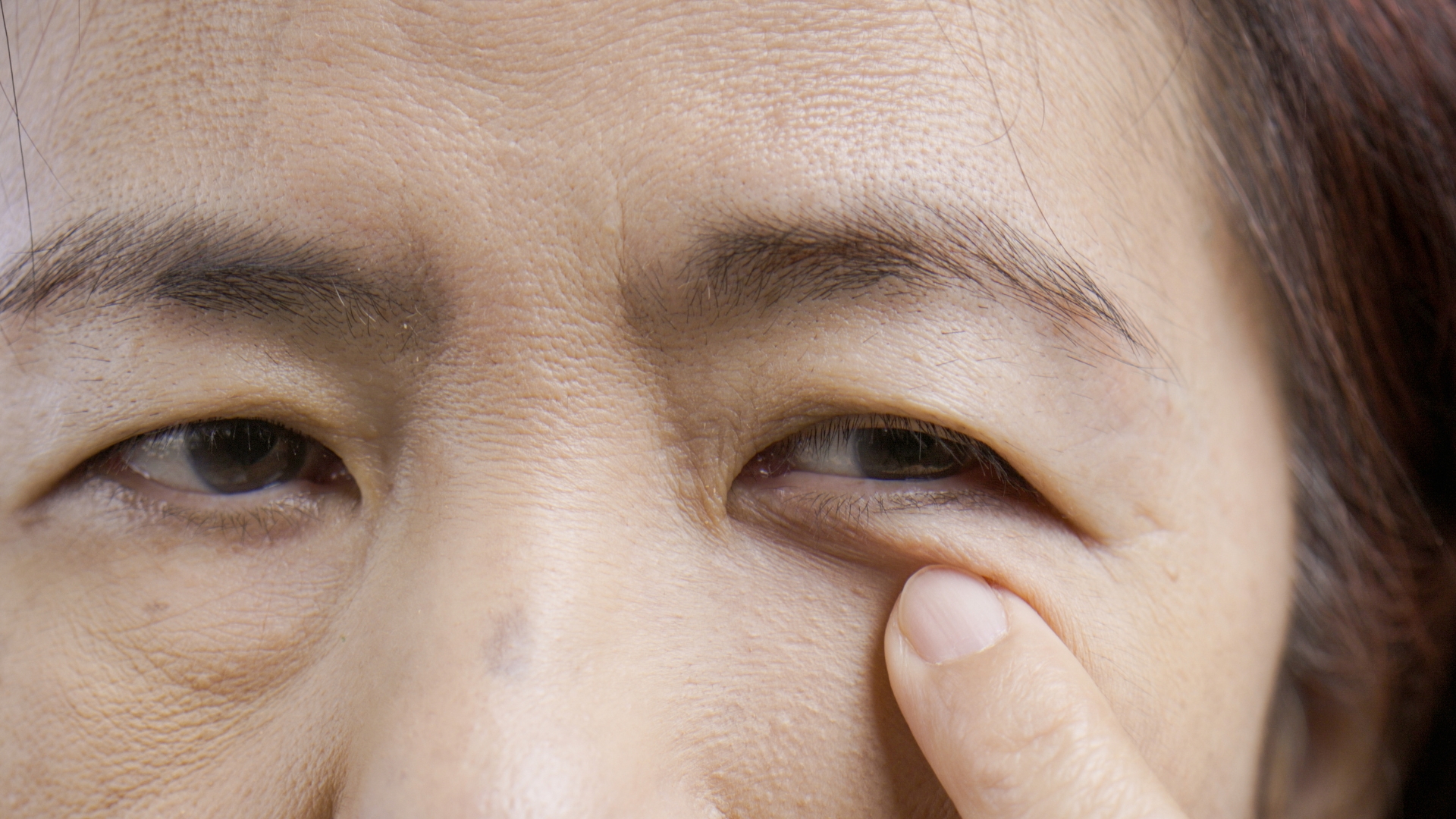 Lão hóa là nguyên nhân hàng đầu gây bọng mắt