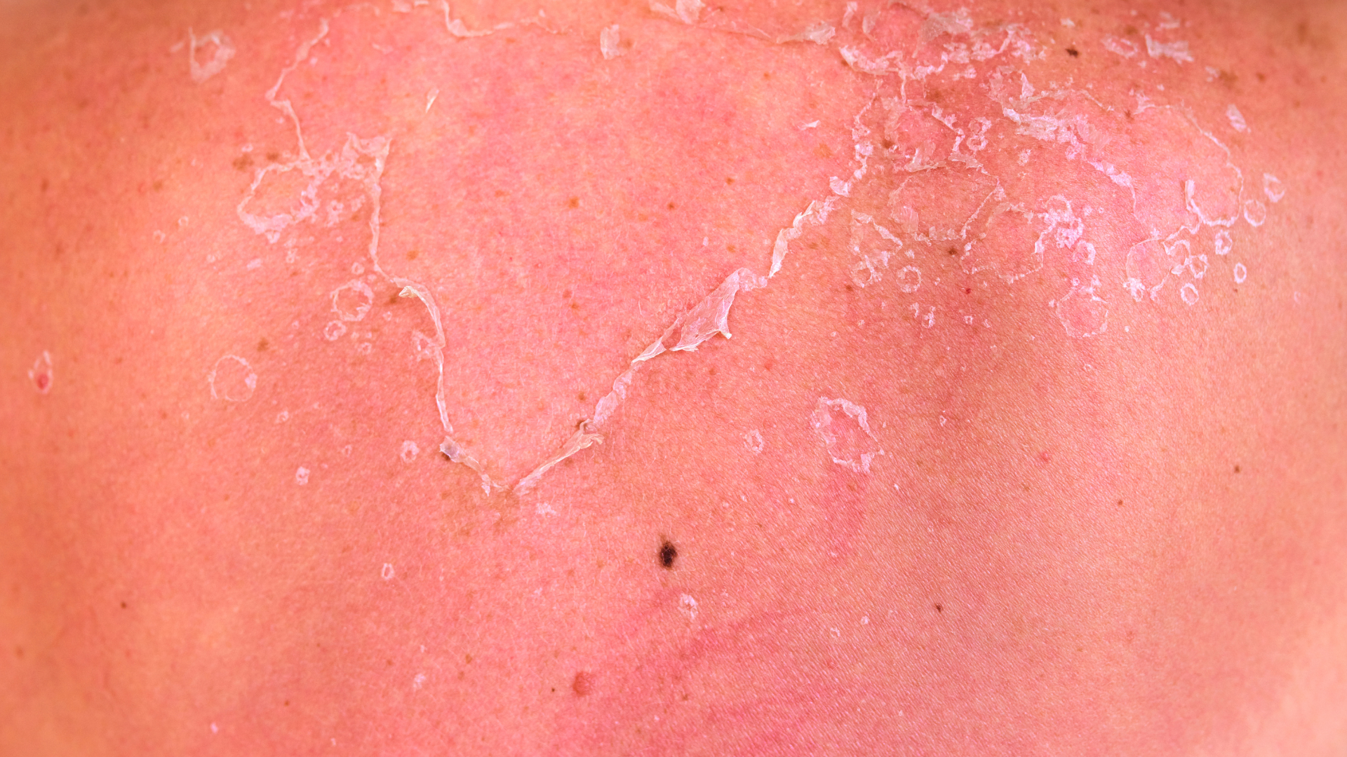 Tổn thương da do bỏng nắng có thể gây nhiễm trùng thứ phát