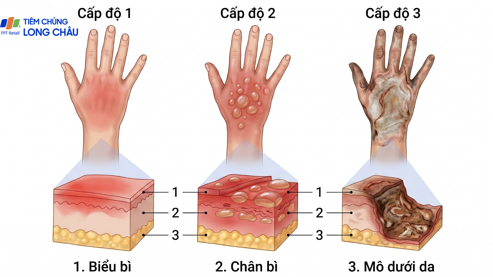 Phân loại mức độ giúp đánh giá chính xác tình trạng