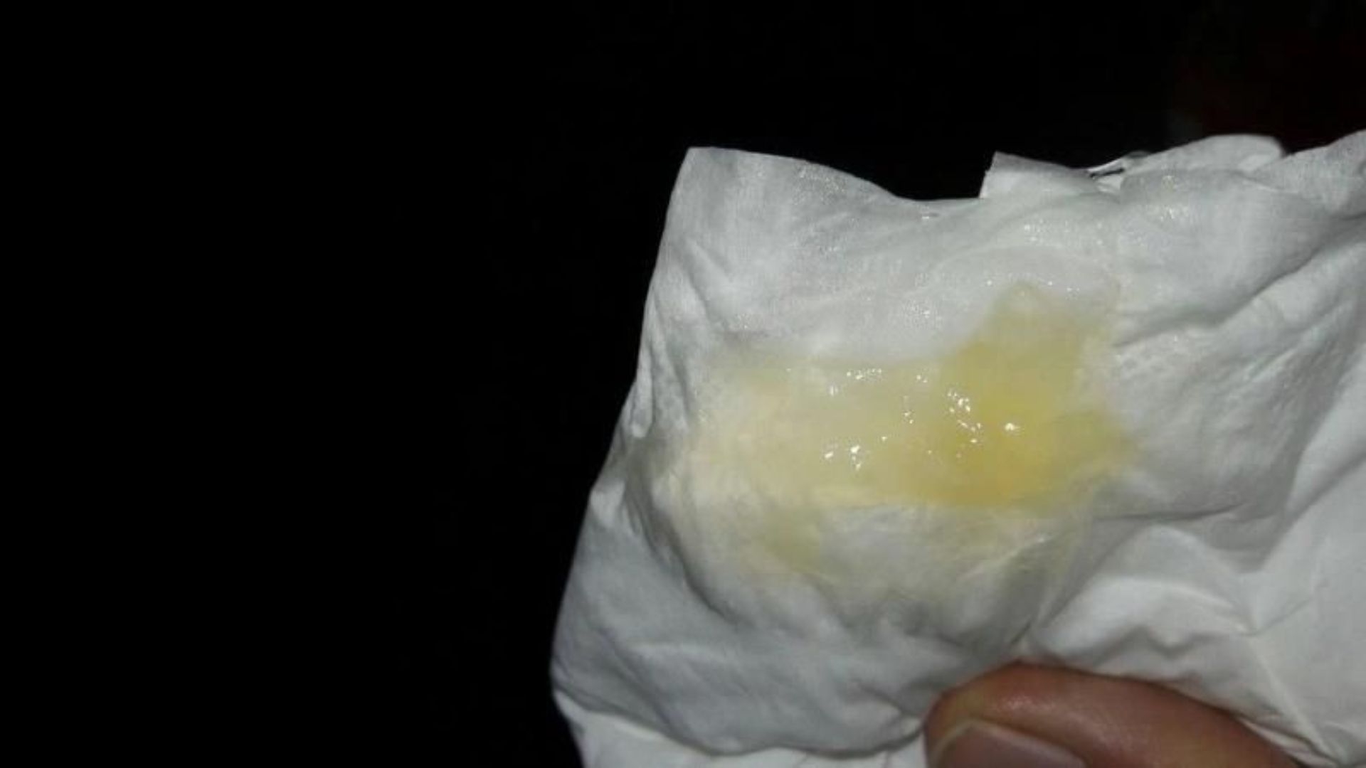 Mẹ có thể nhận biết tình trạng bong nút nhầy cổ tử cung thông qua dịch âm đạo