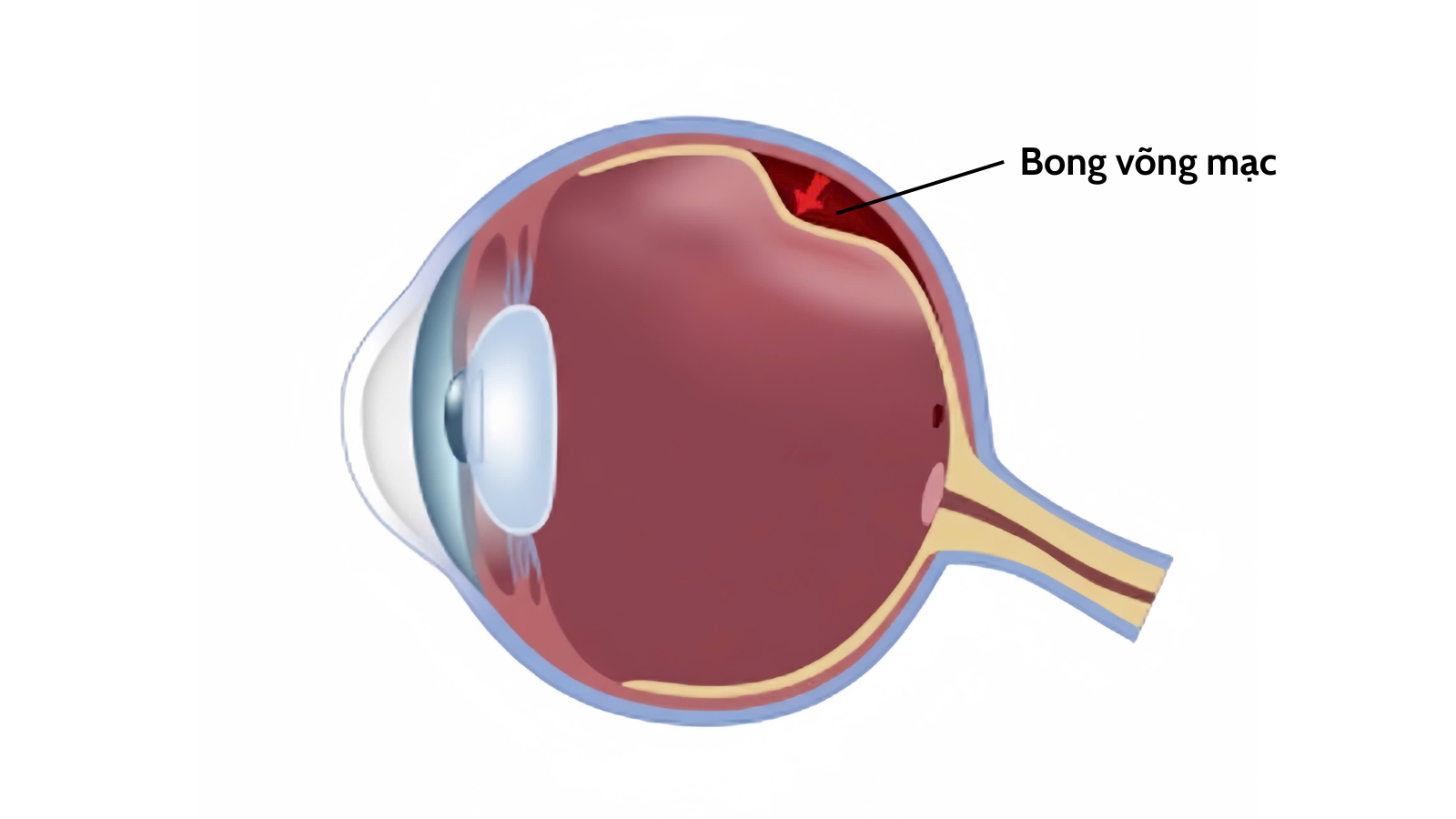 Bong võng mạc cần được xử trí nhanh chóng và kịp thời để bảo vệ thị lực