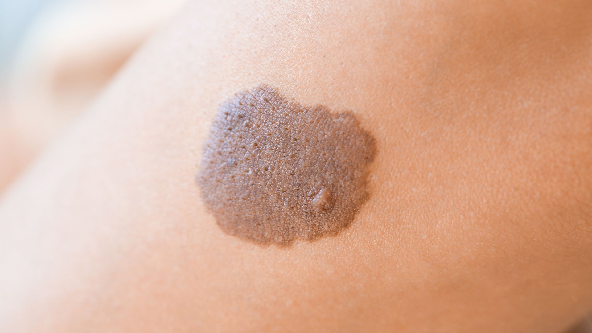 Bớt bẩm sinh là những vết đổi màu trên da xuất hiện ngay từ khi sinh ra