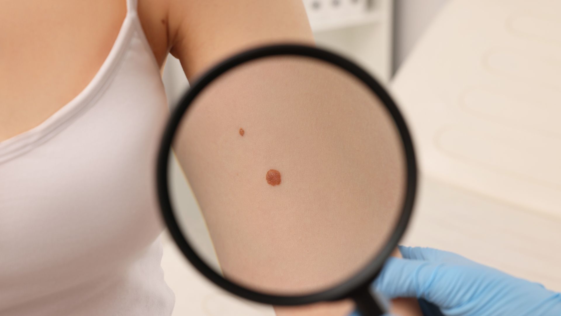 Kích thước của bớt bẩm sinh có sự thay đổi theo thời gian