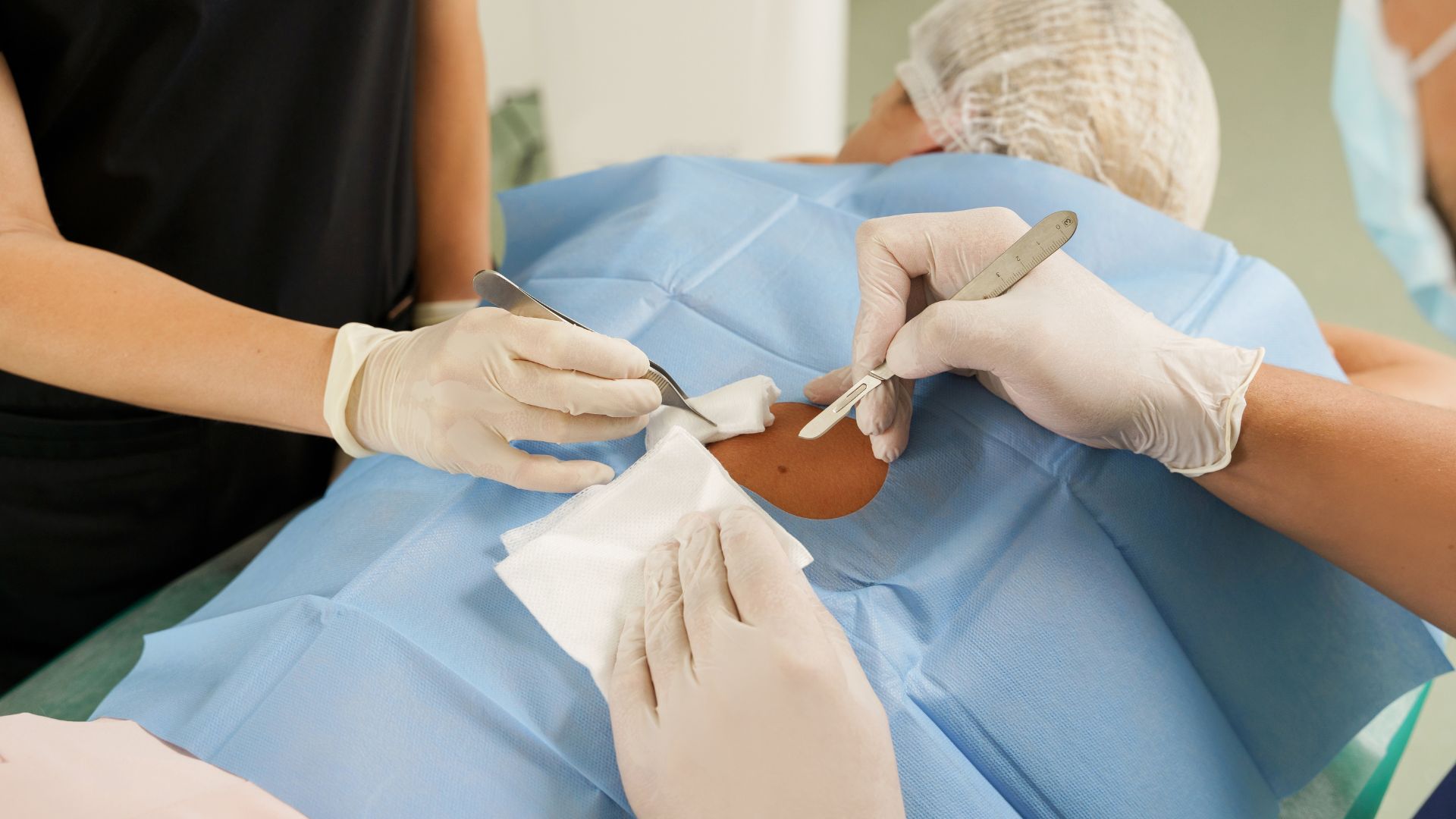 Quyết định phẫu thuật cần được cân nhắc kỹ lưỡng dựa trên lợi ích, nguy cơ và nên do bác sĩ chuyên khoa da liễu hoặc phẫu thuật tạo hình thực hiện