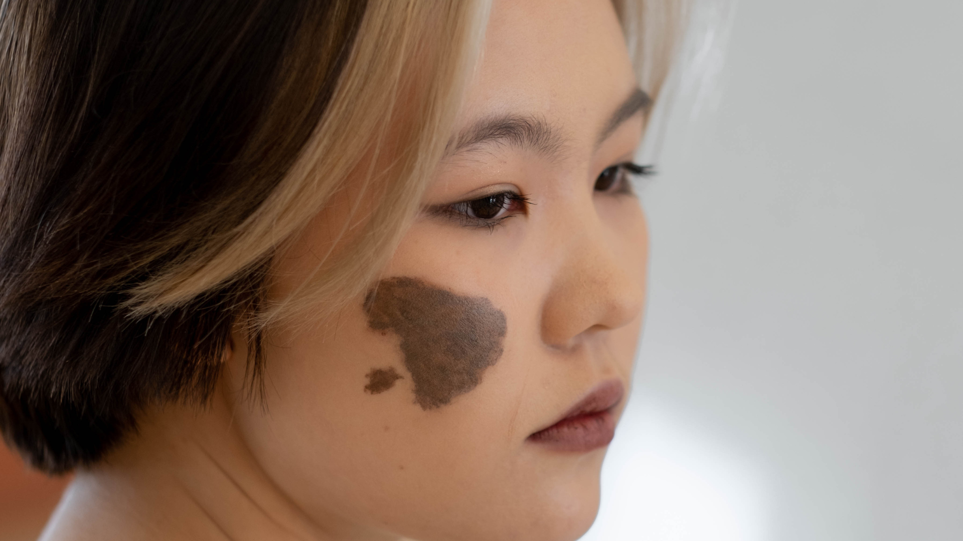 Việc phân loại kích thước bớt giúp đánh giá nguy cơ và lựa chọn cách theo dõi phù hợp