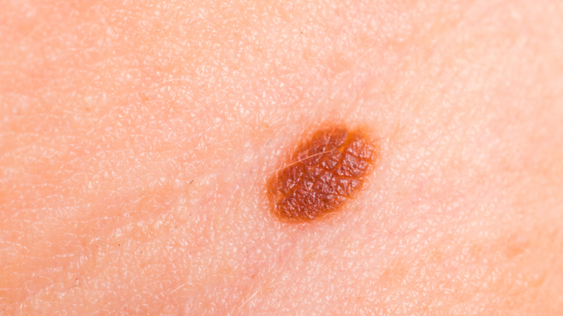 Bớt sùi thượng bì thường xuất hiện từ khi sinh ra hoặc trong những năm đầu đời