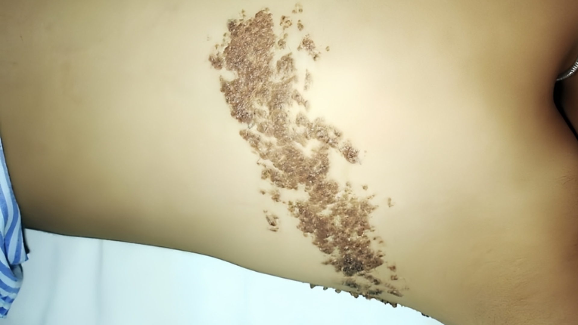 Bớt sùi thượng bì là một dạng tổn thương da lành tính ,không gây nguy hiểm trực tiếp