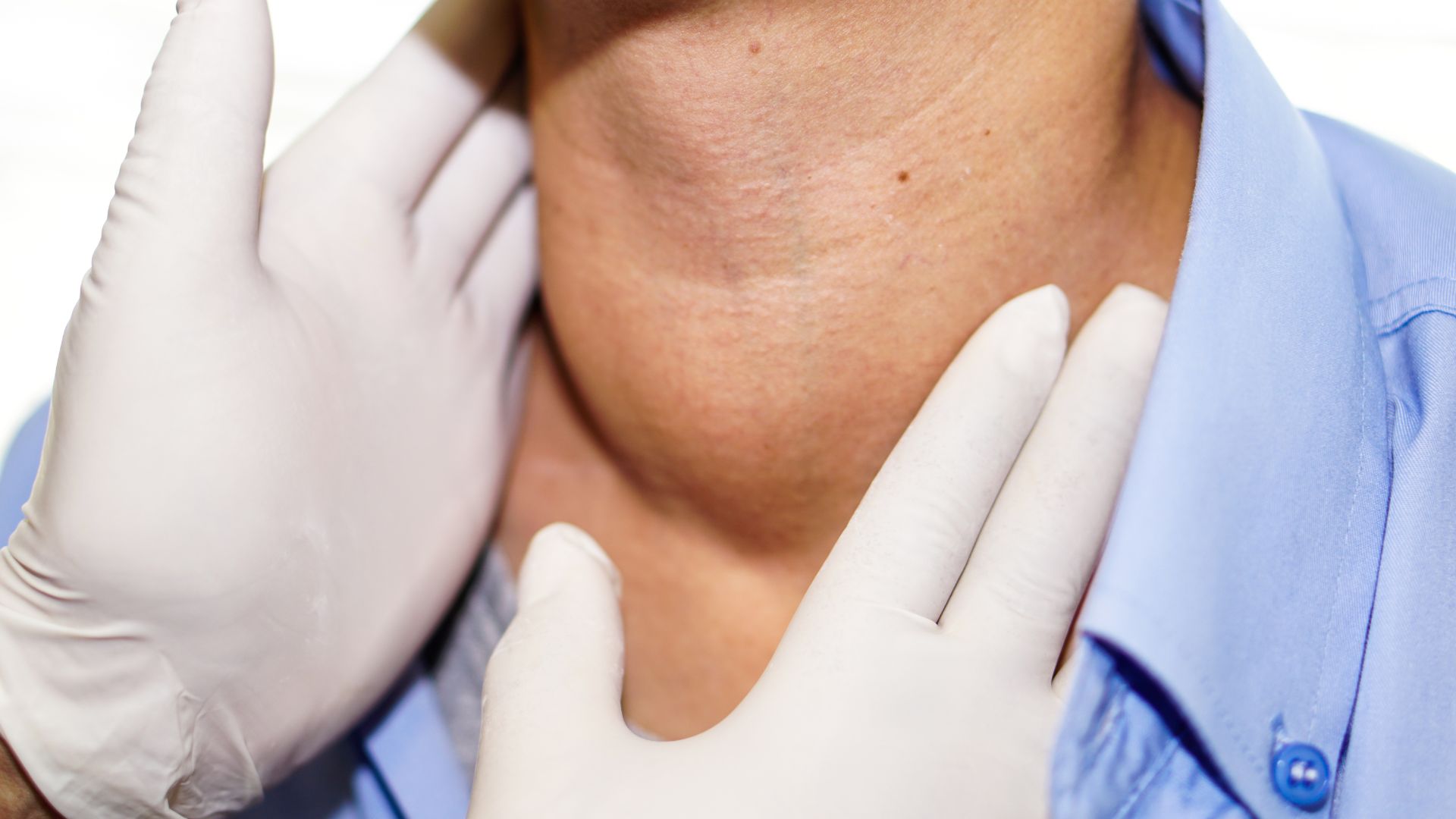 Cổ phình to dần là một dấu hiệu nhận biết bướu cổ