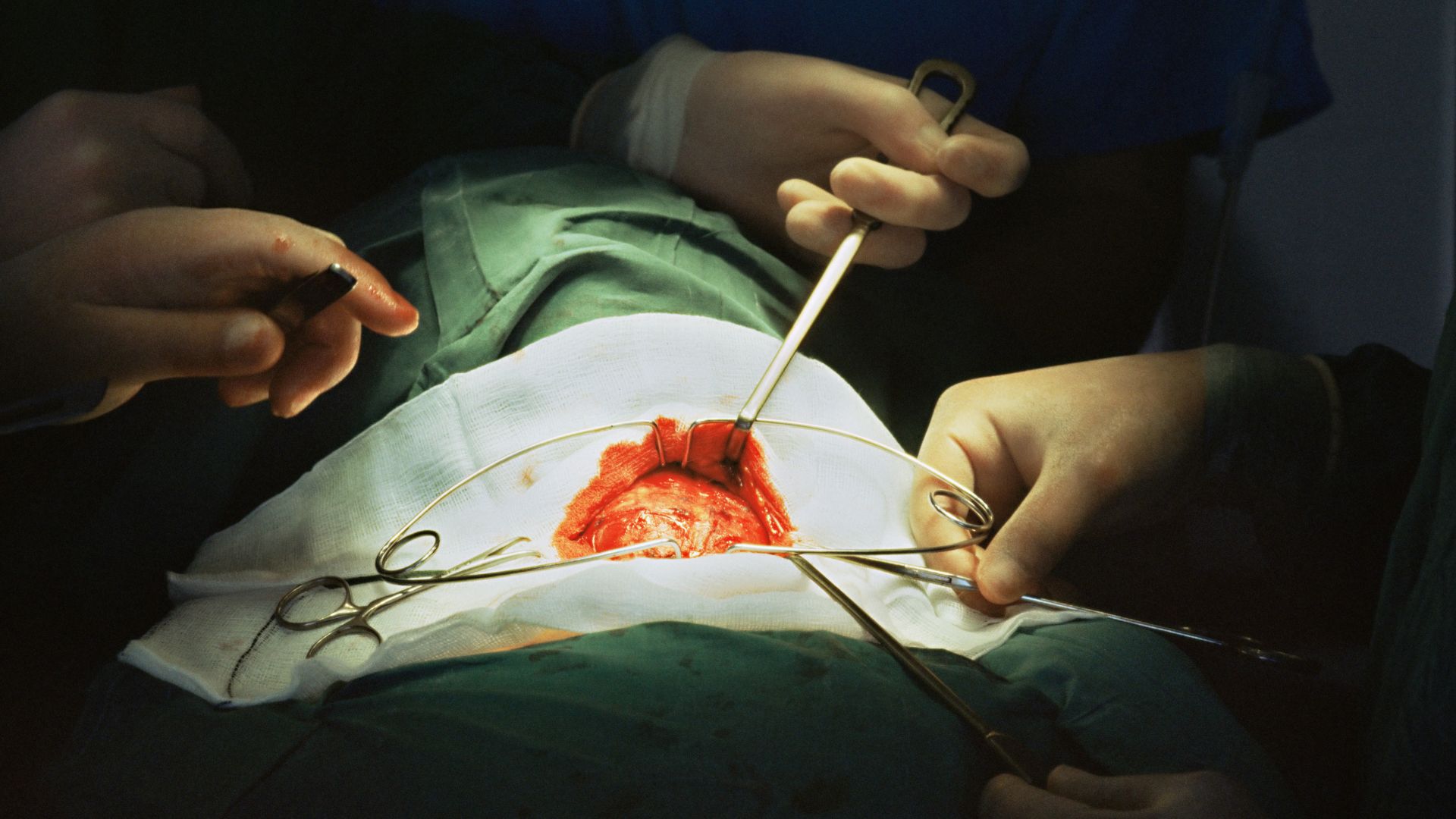 Phẫu thuật cắt bỏ tuyến giáp được chỉ định khi kích thước tuyến giáp lớn quá 4cm