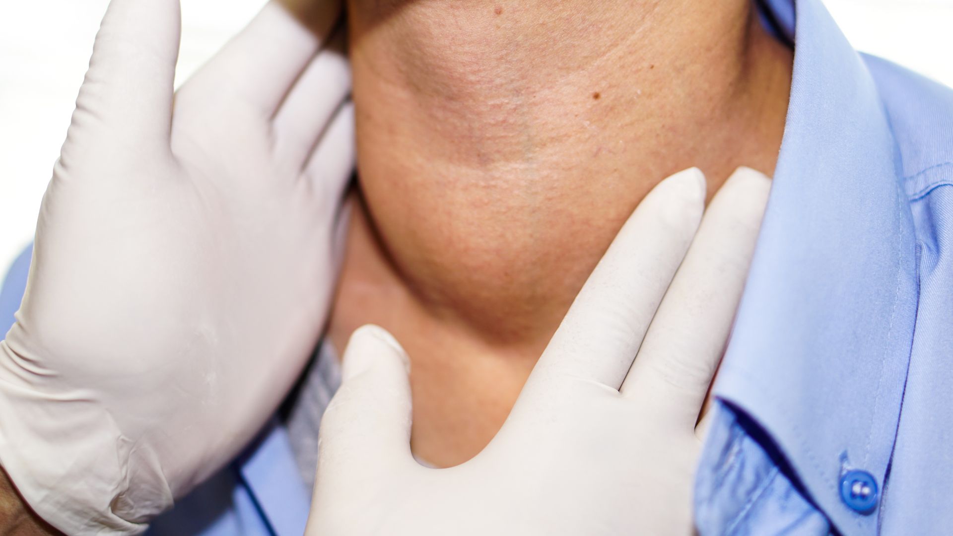 Bướu cổ lành tính xảy ra khi tuyến giáp phình to nhưng không có tế bào ung thư