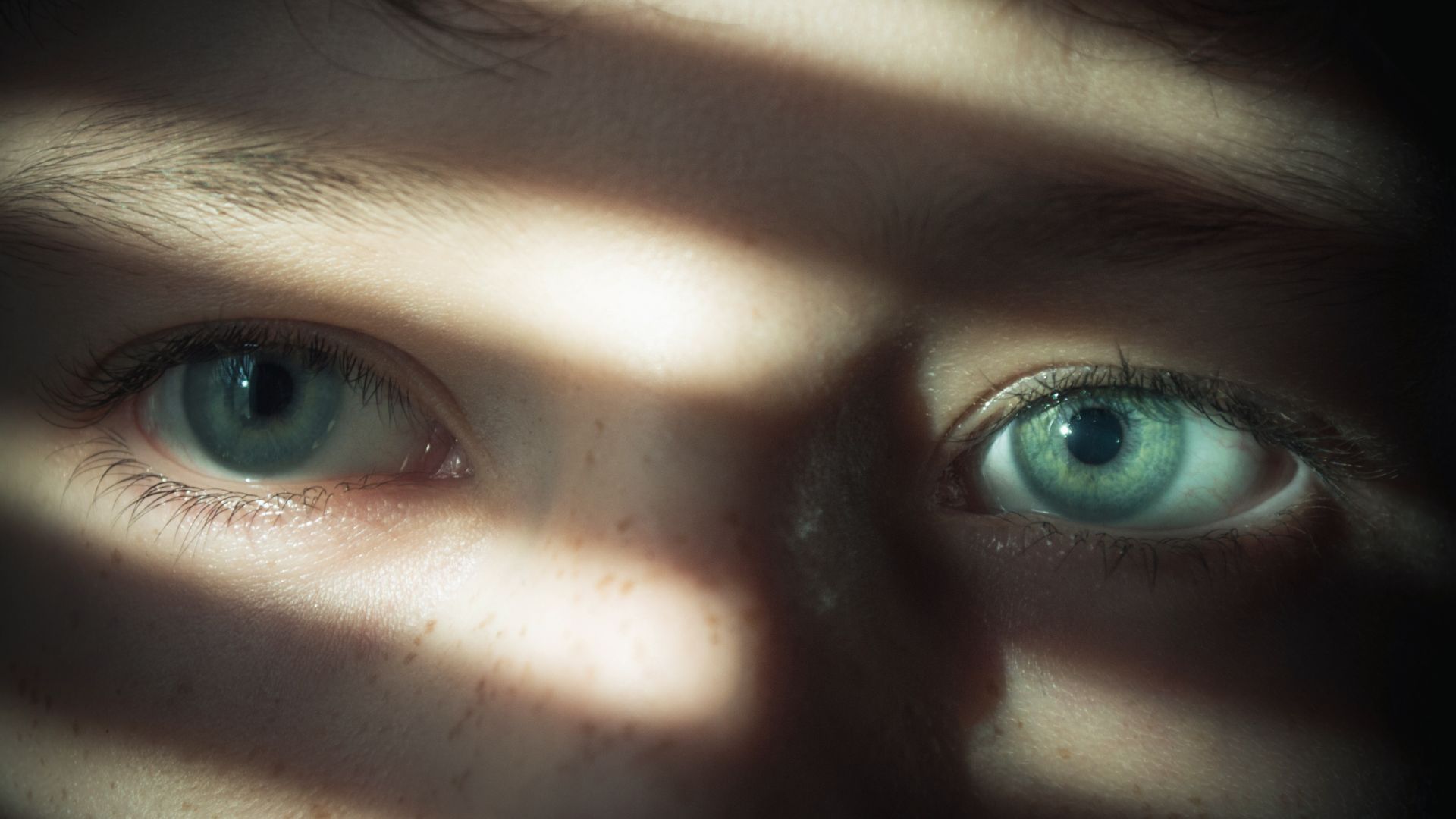 Lồi mắt là biểu hiện thường gặp trong bệnh Basedow, ảnh hưởng thẩm mỹ và thị lực của người mắc bệnh