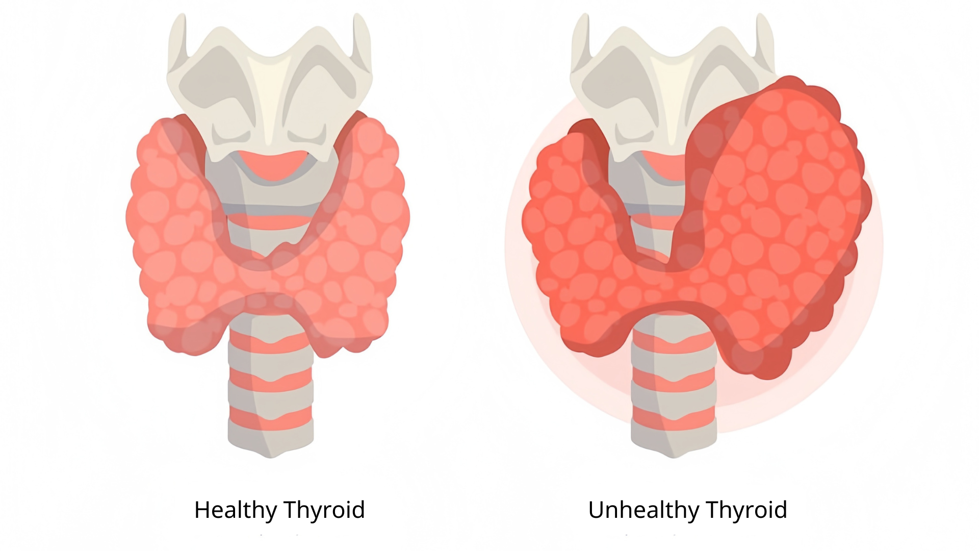 Bướu giáp đa nhân là tình trạng tuyến giáp xuất hiện nhiều nhân (từ hai nhân trở lên)