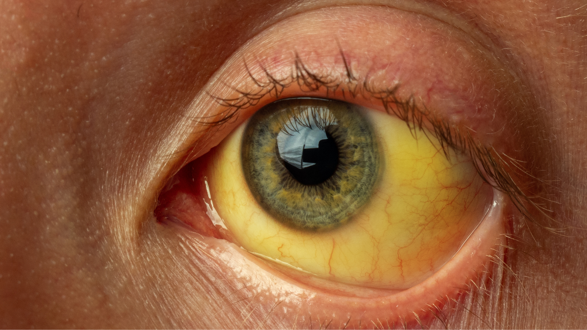 cac-benh-lay-qua-duong-nuoc-bot-co-the-ban-chua-biet (3).png