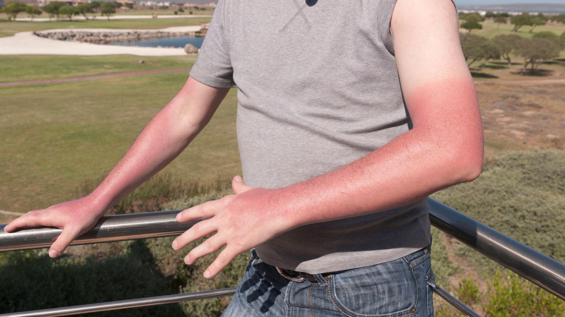 Tiếp xúc với ánh nắng mặt trời gây cháy nắng