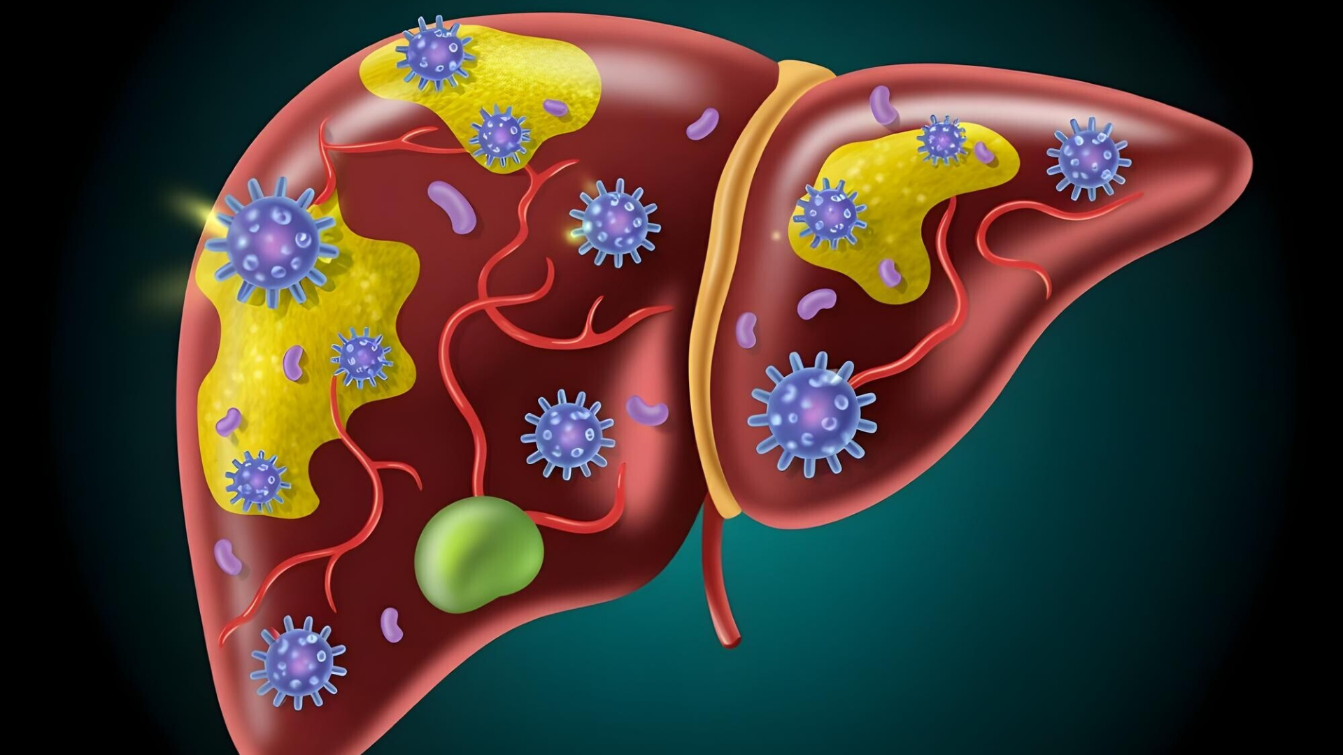 Một trong những nguyên nhân phổ biến nhất gây các bệnh về gan là nhiễm virus viêm gan