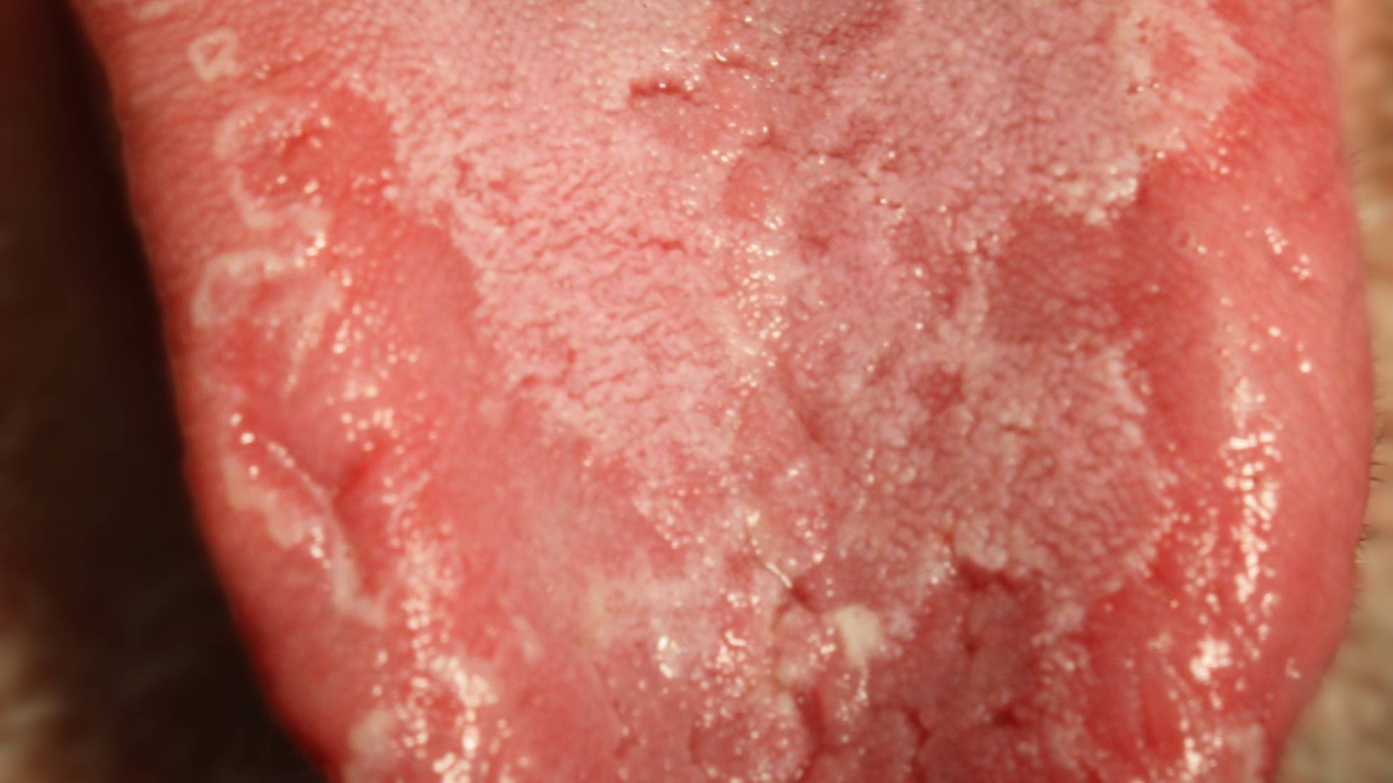 Nguyên nhân gây nên các bệnh về lưỡi có thể do vi khuẩn, virus hoặc nấm Candida