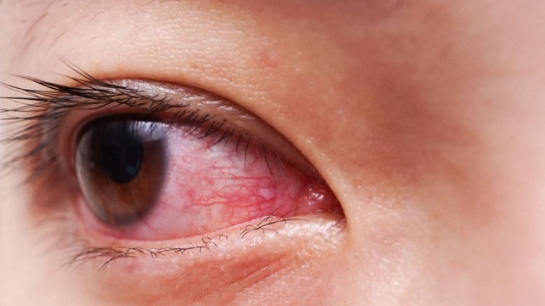 Mắt đỏ kéo dài thường do viêm kết mạc, dị ứng, khô mắt hoặc nhiễm trùng