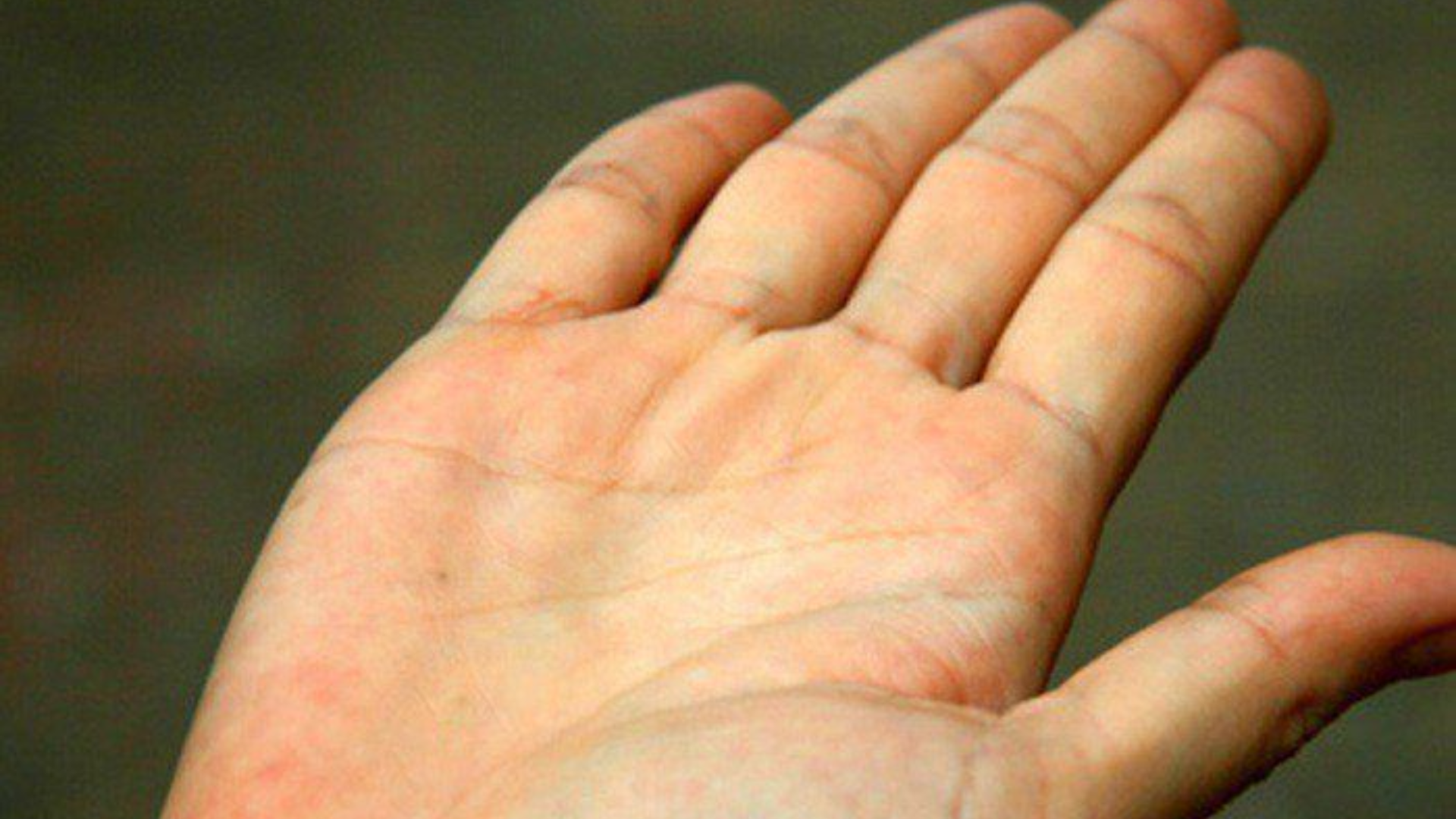 Nóng gan khiến da và mắt vàng, cảnh báo chức năng gan đang suy giảm rõ rệt