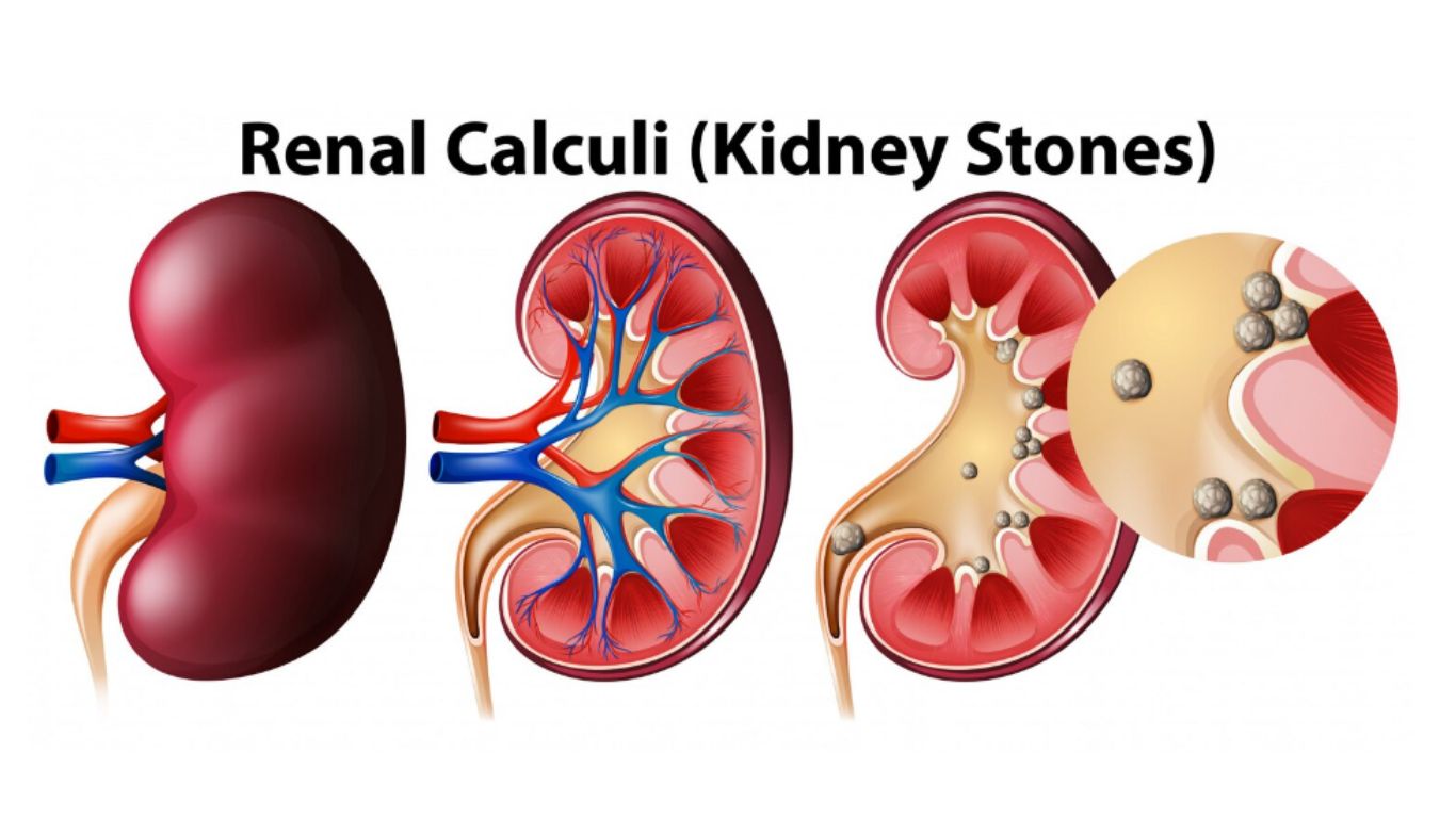 Các dấu hiệu sỏi thận​ thường gặp là gì? Phương pháp điều trị sỏi thận 1