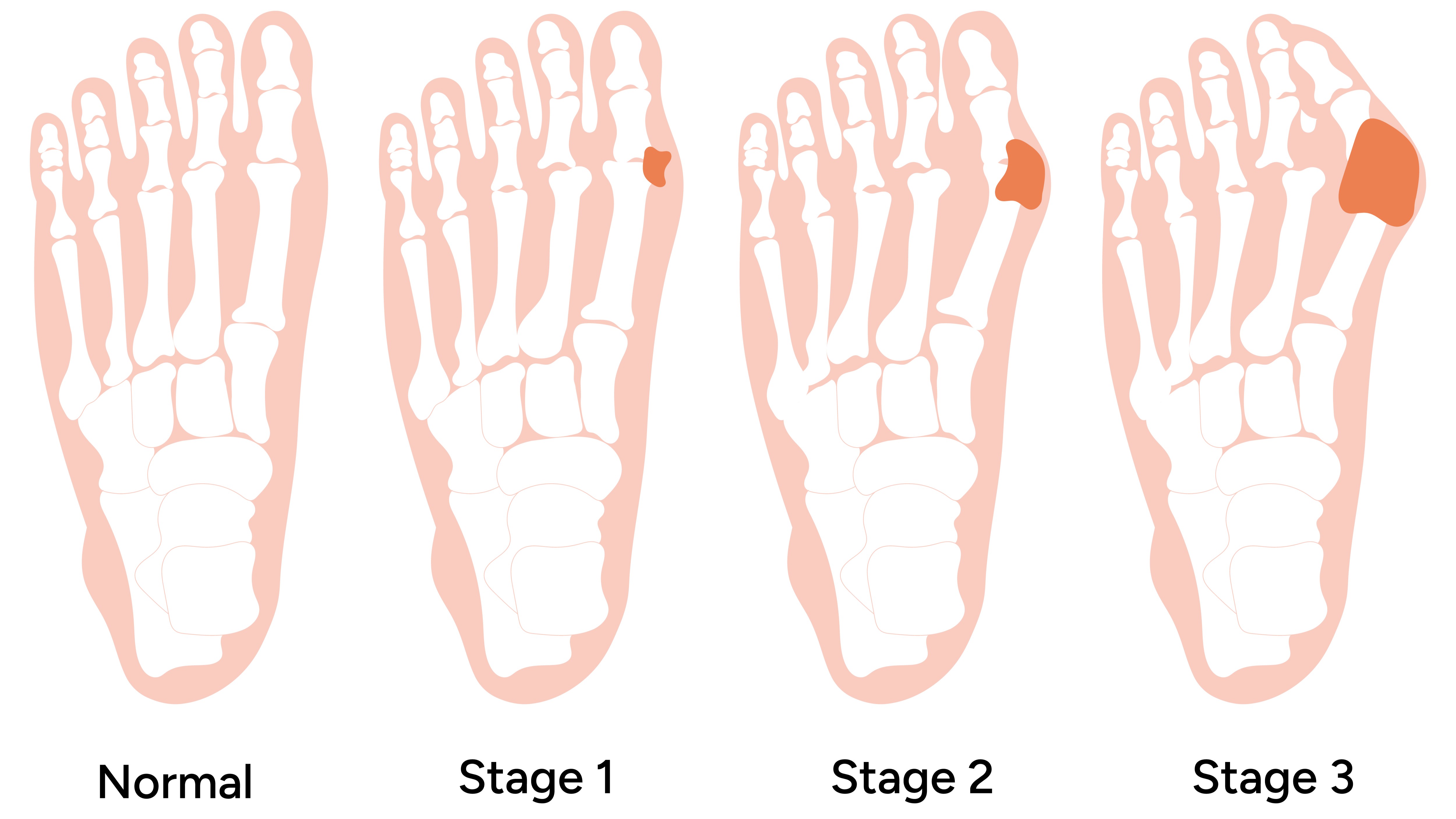 Minh họa hình ảnh bệnh gout theo từng giai đoạn