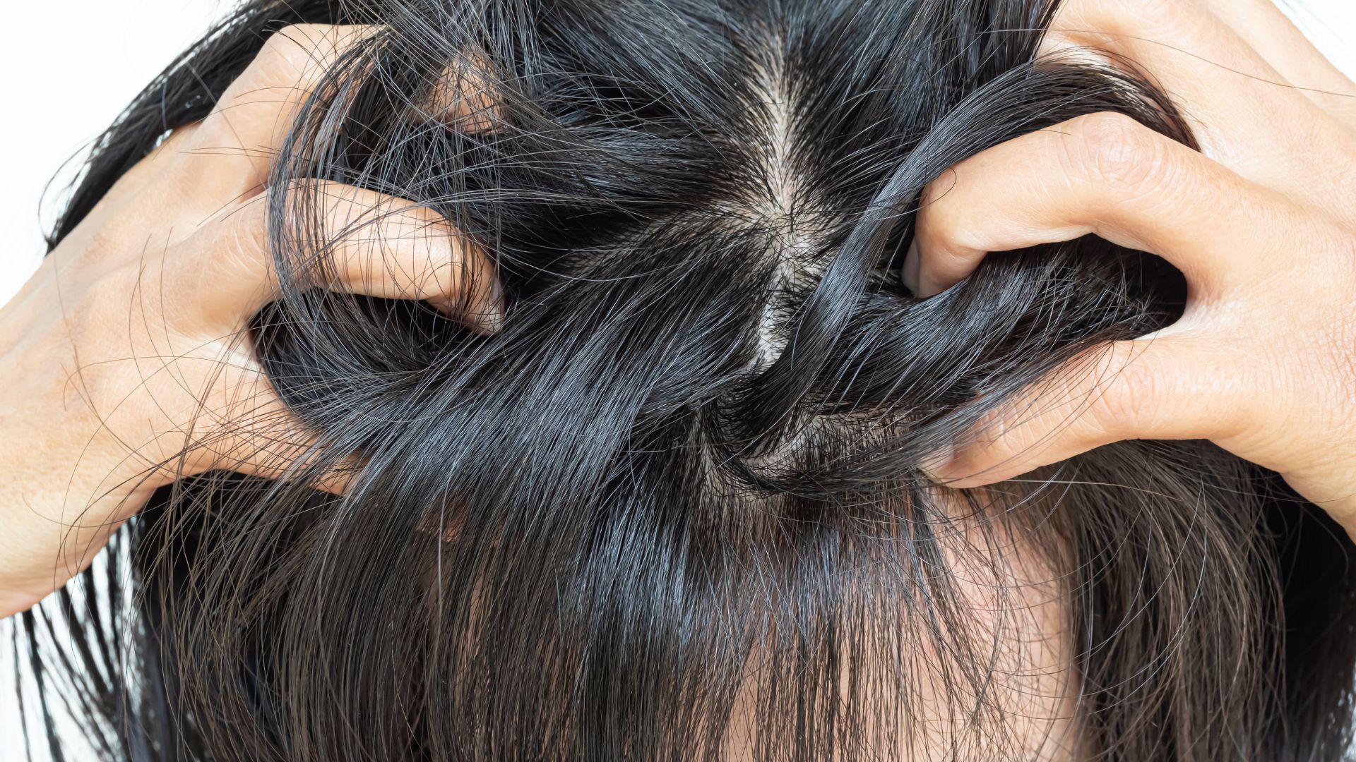 Nấm da đầu thường gây ngứa, bong vảy và rụng tóc