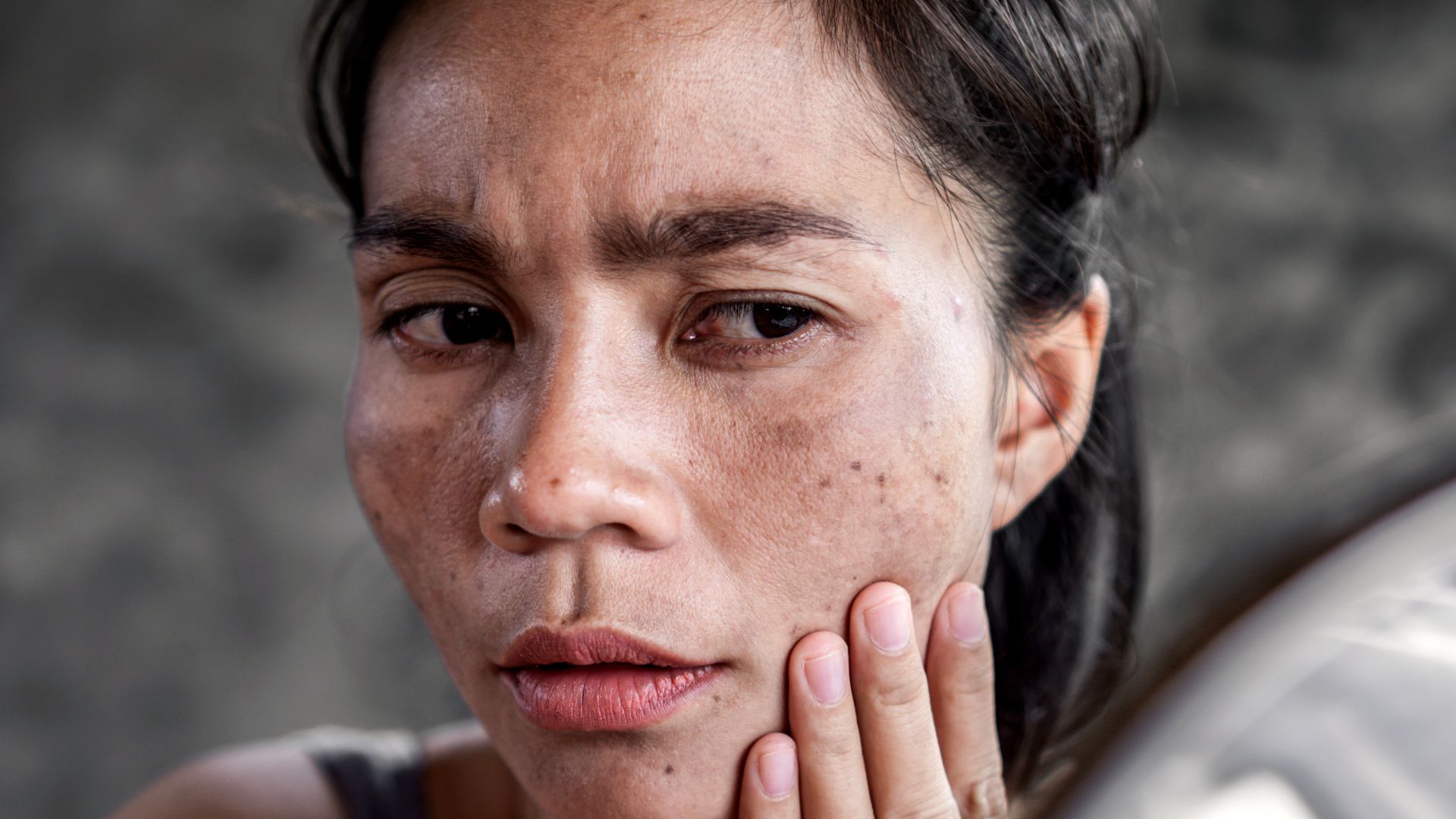 Mô phỏng các loại nám da thường gặp giúp dễ dàng nhận biết vùng ảnh hưởng