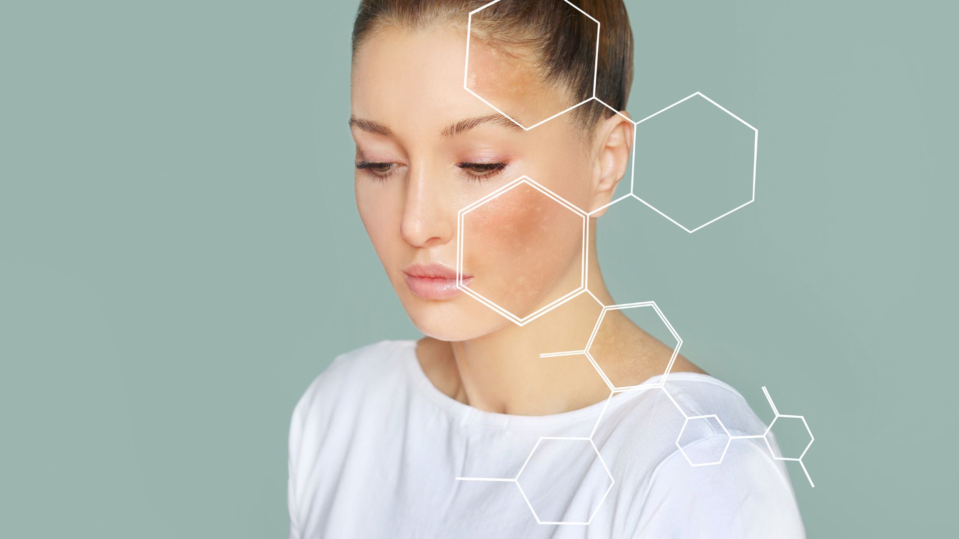 Ba dạng nám phổ biến có sự khác biệt rõ về độ sâu và màu sắc trên da