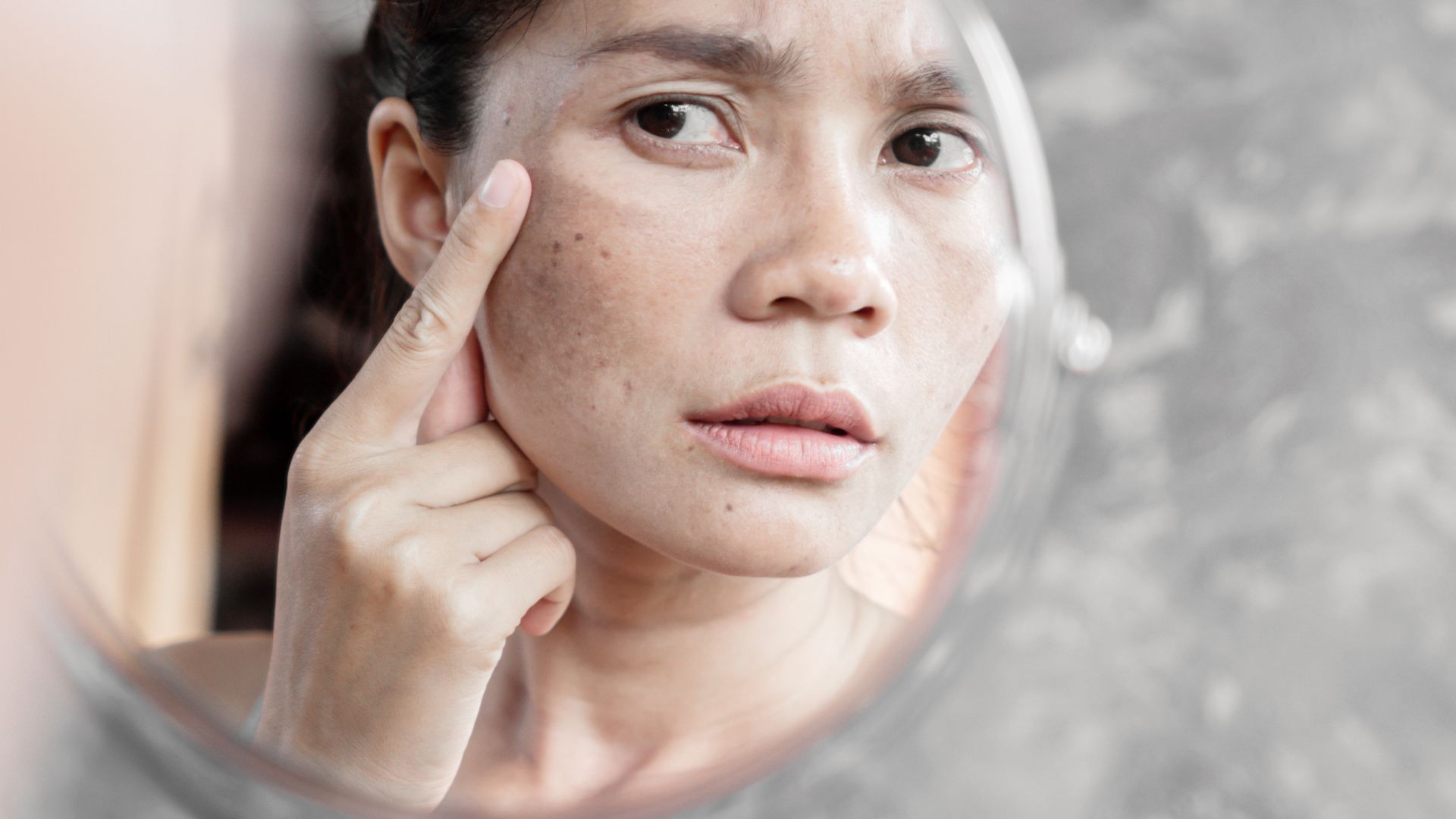 Nhiều yếu tố môi trường và lối sống có thể làm nám xuất hiện hoặc lan rộng nhanh hơn