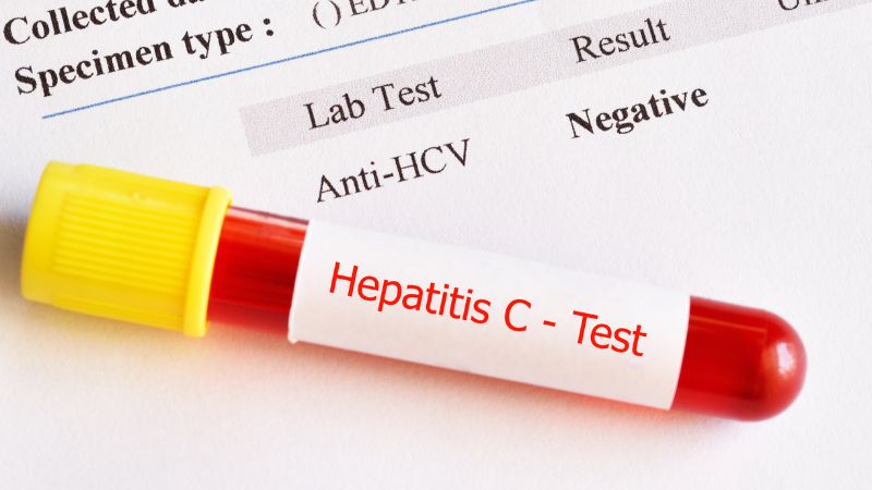 Nhiễm viêm gan C có nguy cơ cao tiến triển thành xơ gan và ung thư gan