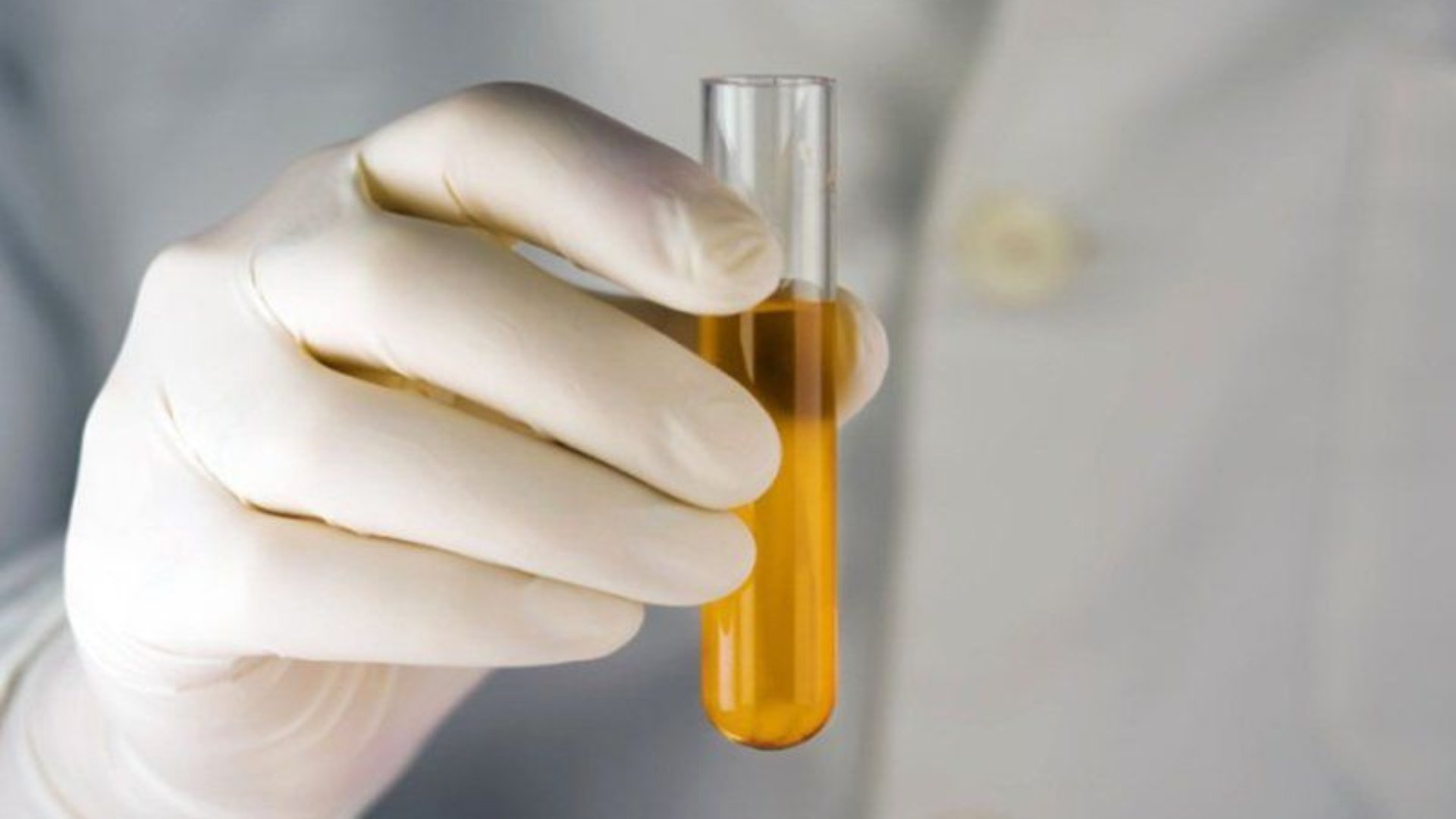 Glucose dương tính có thể gặp ở người tiểu đường, thai kỳ hoặc sau khi ăn ngọt nhiều