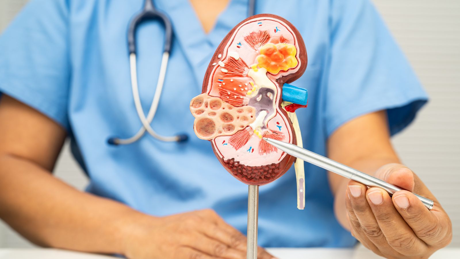 Quá trình viêm nhiễm kéo dài có thể làm mủ tích tụ lại thành các ổ áp xe, gây ra tình trạng thận ứ mủ