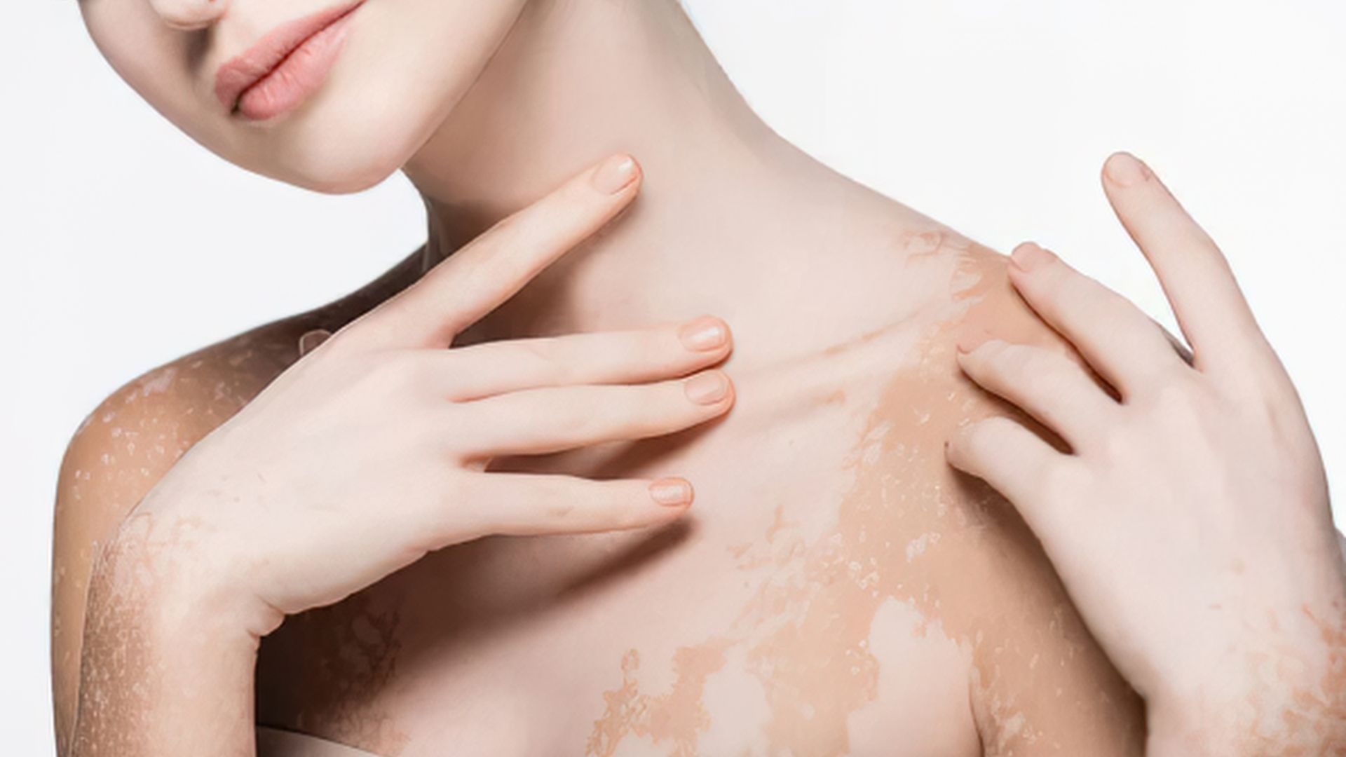 Thuốc bôi tại chỗ là một cách chữa bệnh bạch biến