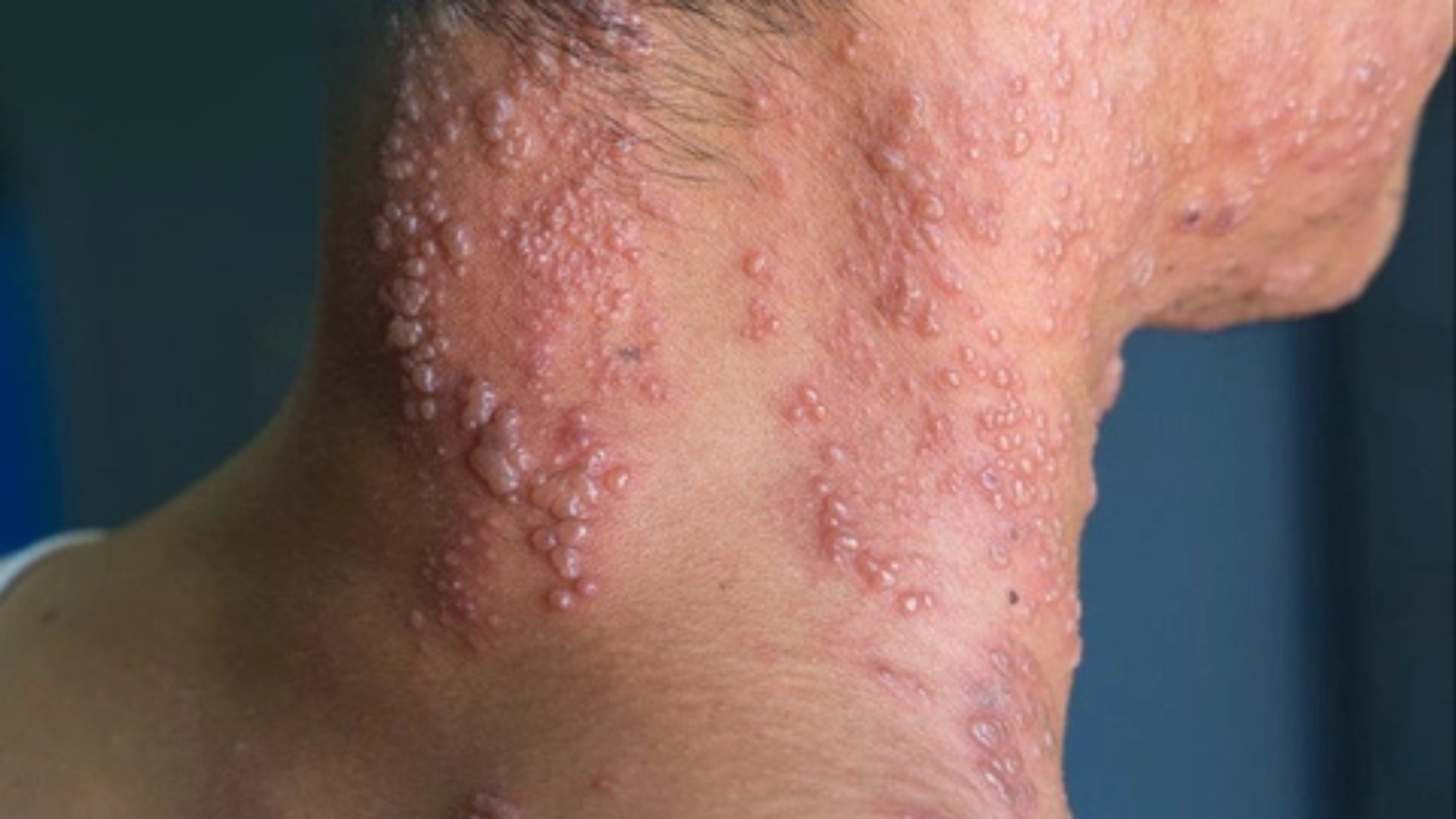 Zona thần kinh không chỉ gây tổn thương da mà còn ảnh hưởng hệ thần kinh