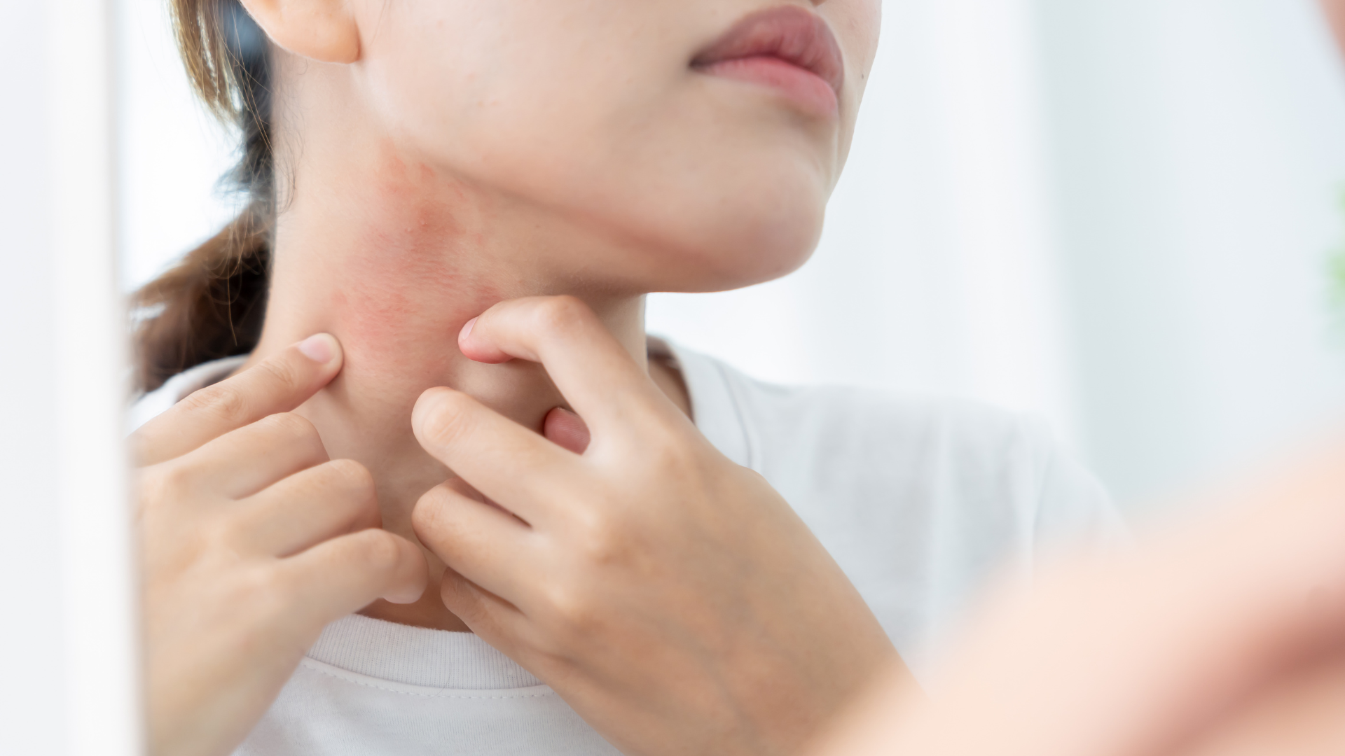 Tránh gãi hoặc chà xát để hạn chế gây nhiễm trùng