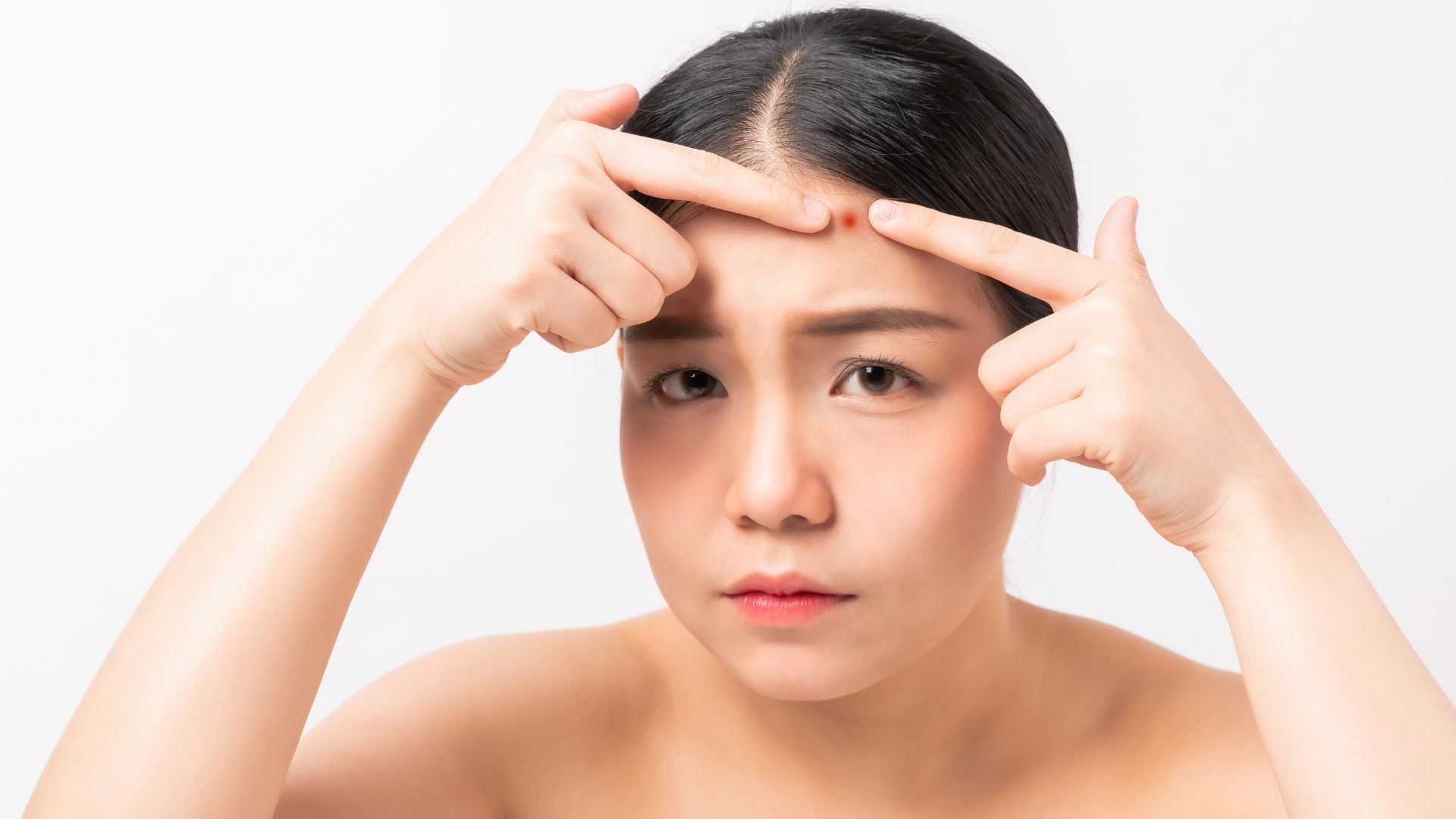 Cách chữa mụn nhọt đầu đinh hiệu quả: Top 6 phương pháp an toàn nên áp dụng 1