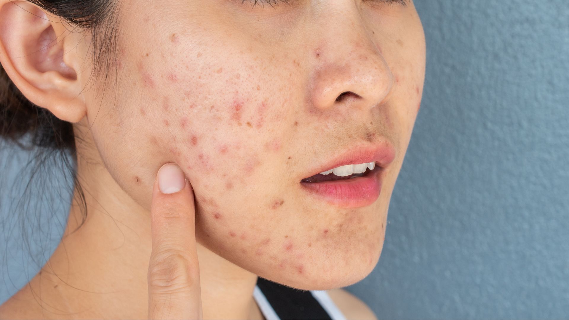 Cách chữa mụn nhọt đầu đinh hiệu quả: Top 6 phương pháp an toàn nên áp dụng 3