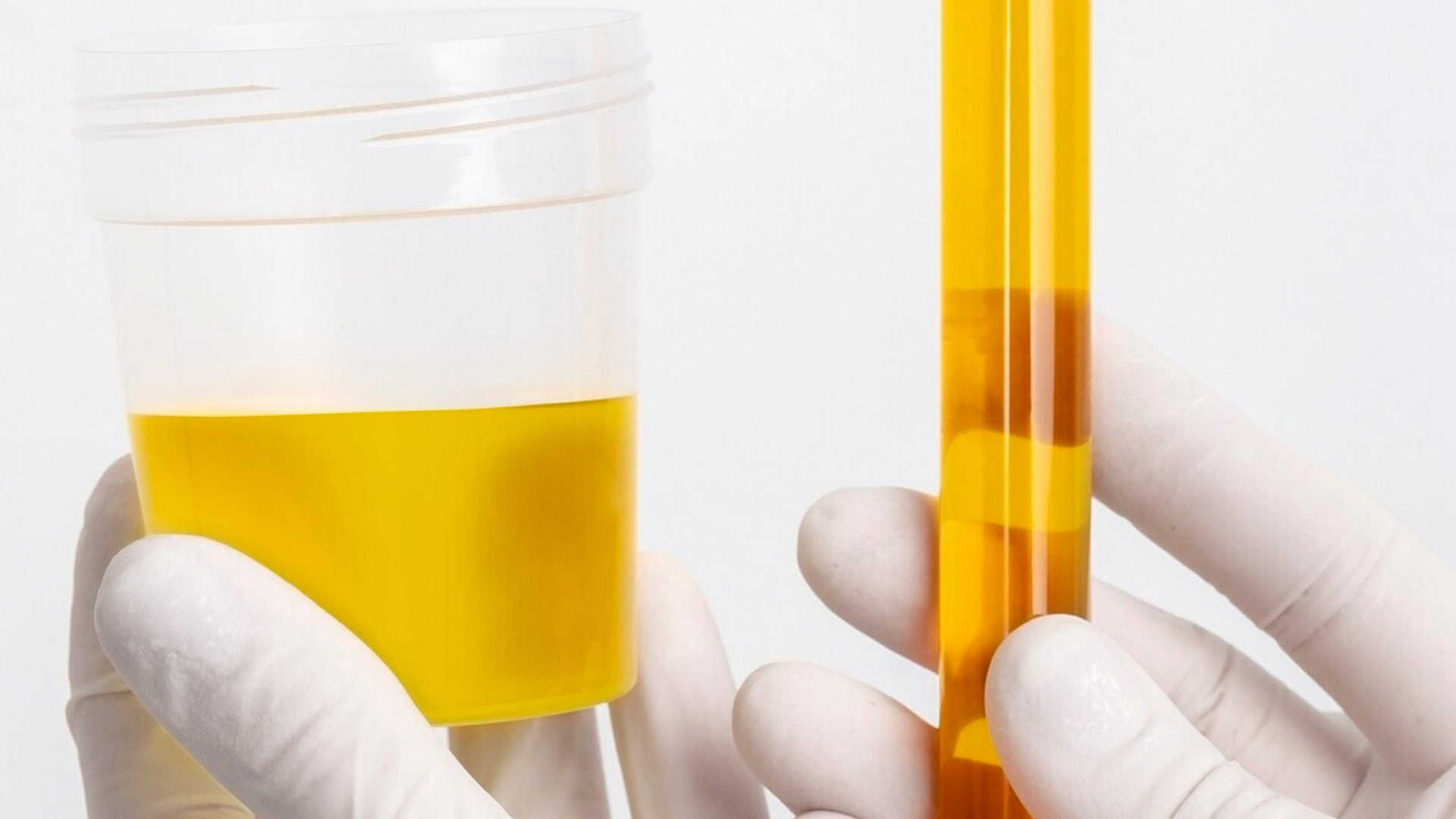 Xét nghiệm nước tiểu định kỳ cũng giúp theo dõi mức độ pH và nồng độ khoáng chất