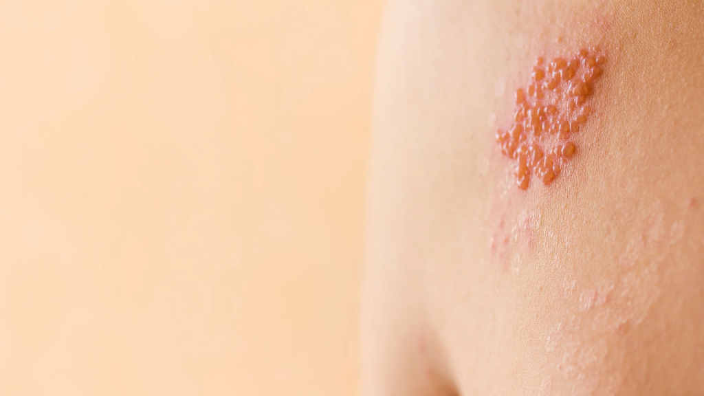 cach-chua-zona-than-kinh-an-toan-va-hieu-qua-tai-nha 3.png