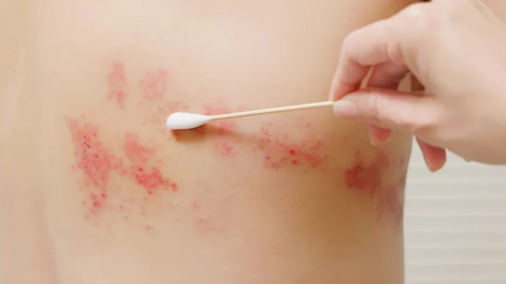 cach-chua-zona-than-kinh-an-toan-va-hieu-qua-tai-nha 4.png