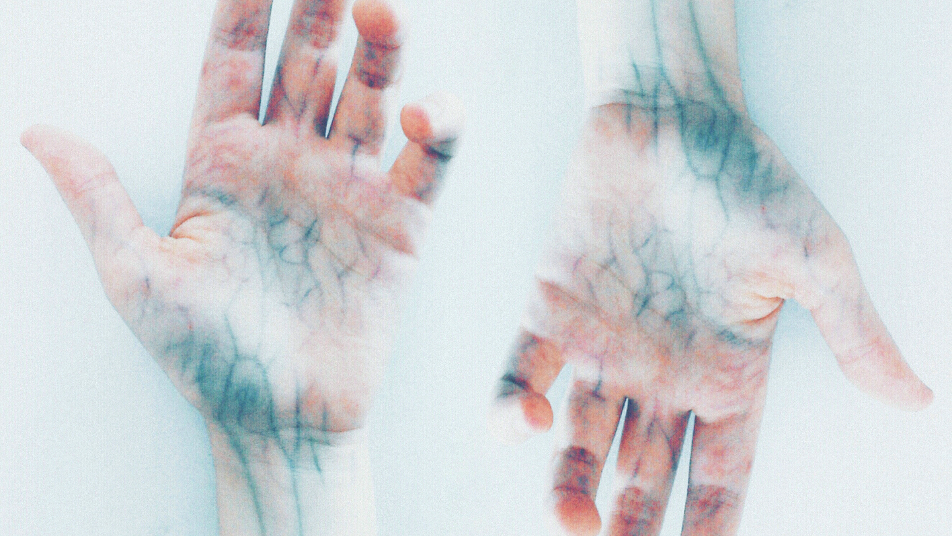 Tìm hiểu các cách điều trị giãn tĩnh mạch phổ biến và an toàn cho sức khỏe