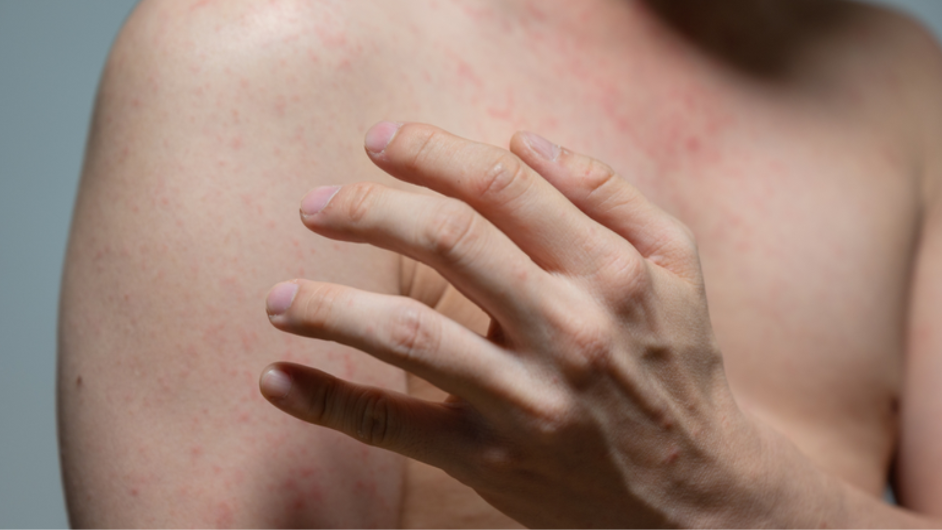 Nổi ban đỏ là một trong những dấu hiệu điển hình khi mắc bệnh sốt phát ban