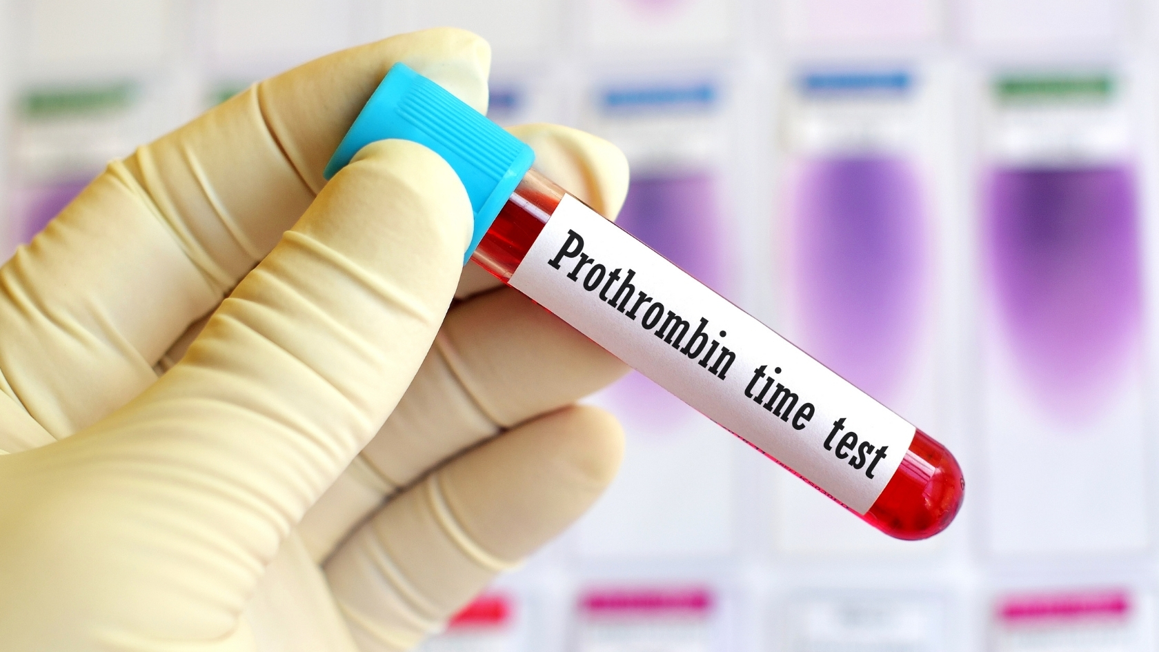 PT đo thời gian đông máu, phản ánh chức năng tổng hợp các yếu tố đông máu vốn được sản xuất bởi gan