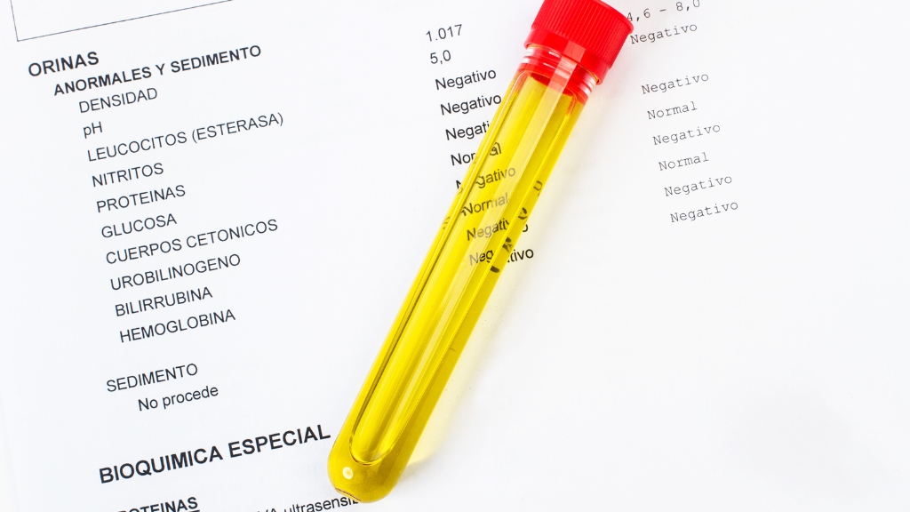 Các chỉ số xét nghiệm nước tiểu phản ánh sức khỏe thận, gan, tiết niệu và chuyển hóa