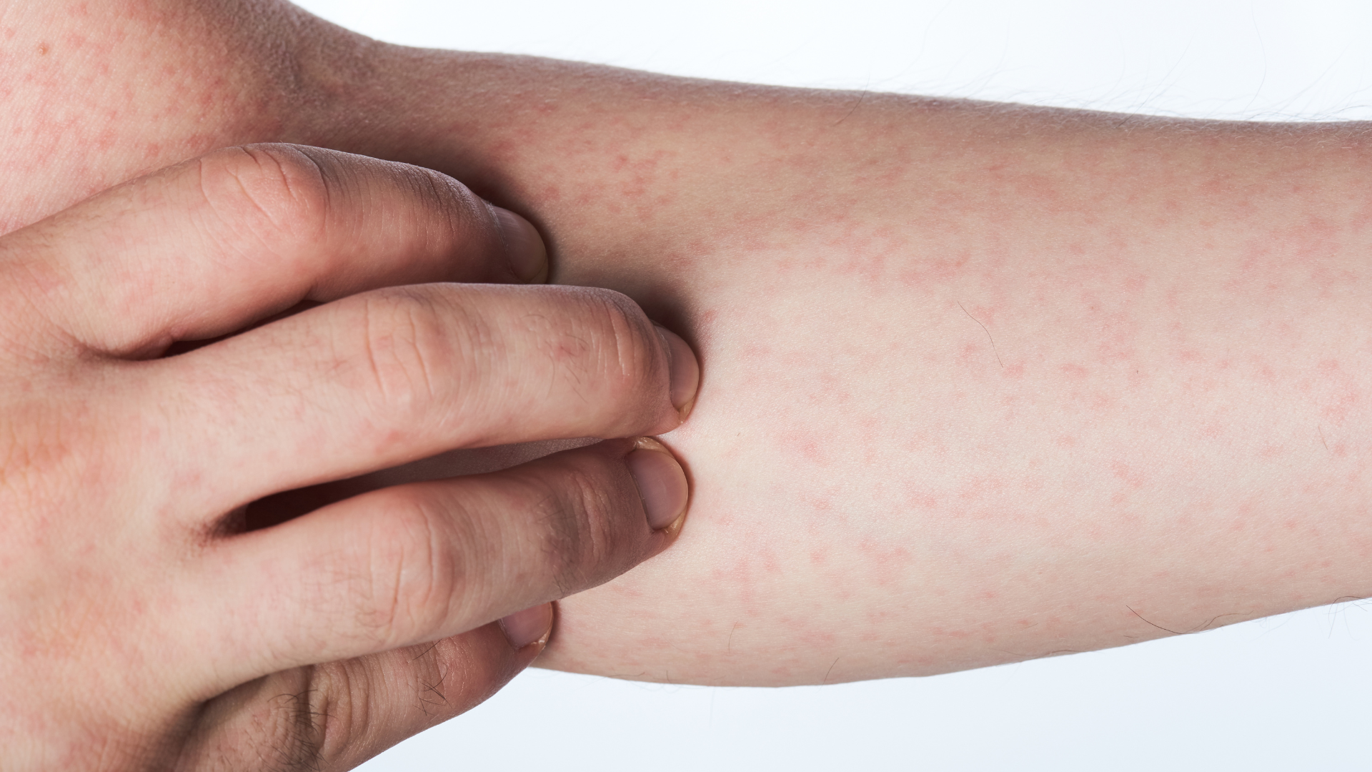 cach-giam-ngua-khi-phat-ban-sot-xuat-huyet-don-gian-ma-hieu-qua 1.png