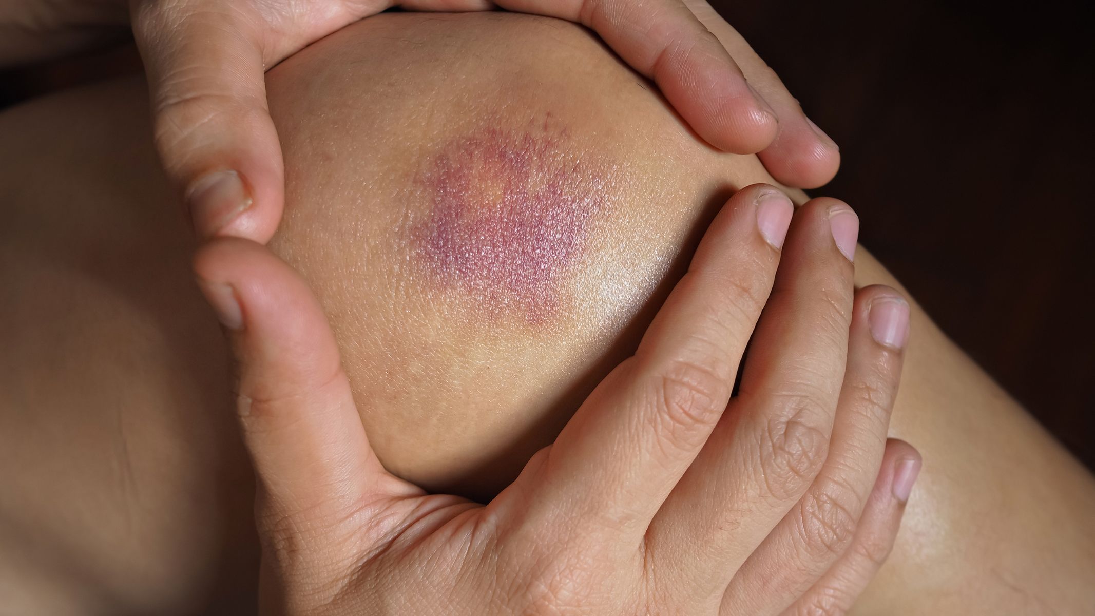 Khi cơ thể chịu tác động lực mạnh từ bên ngoài, các mô mềm và mạch máu nhỏ dưới da dễ bị tổn thương, tạo ra vết bầm tím